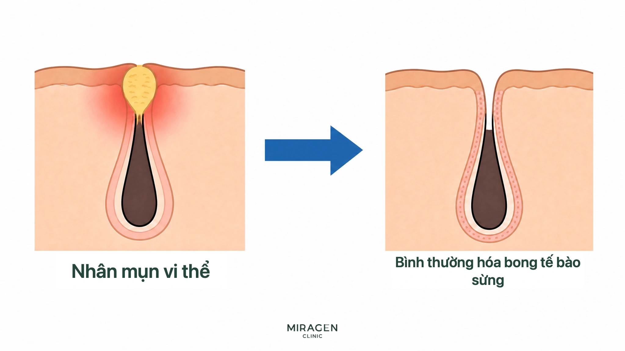 Hình mặt cắt da trước và sau: nhân mụn nhỏ bít nang lông được cải thiện nhờ Differin, miệng lỗ chân lông mở và quá trình bong sừng trở lại bình thường