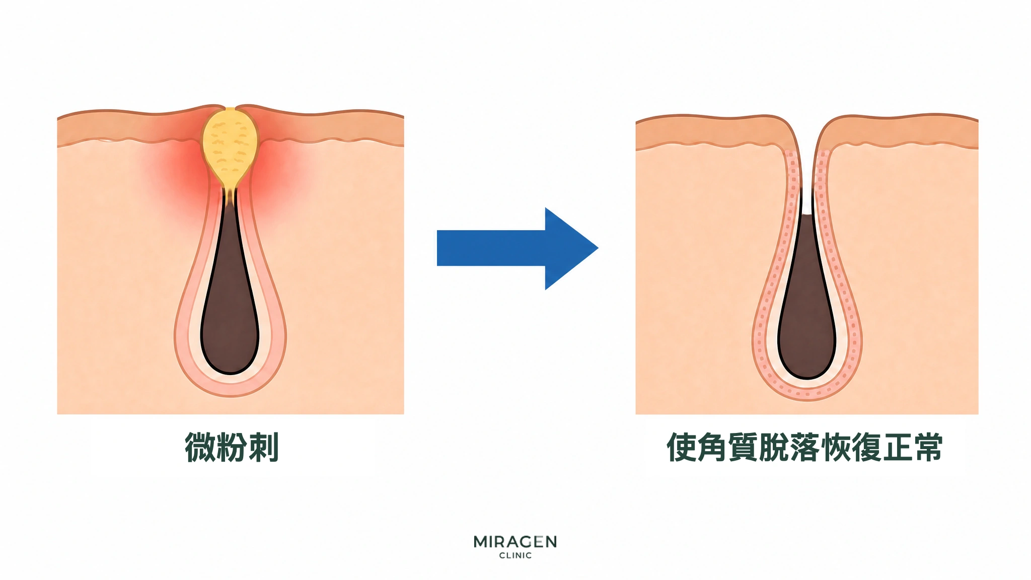 前後對比的皮膚剖面圖:毛孔內原先被角質堵塞的微粉刺在Differin凝膠作用下減少,毛孔入口開啟,角質脫落恢復正常