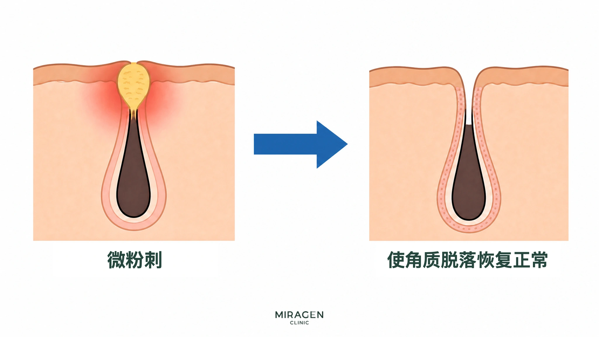 前后对比的皮肤剖面图：毛孔内原先被角质堵塞的微粉刺在达芙文凝胶作用下减少，毛孔入口打开，角质脱落恢复正常