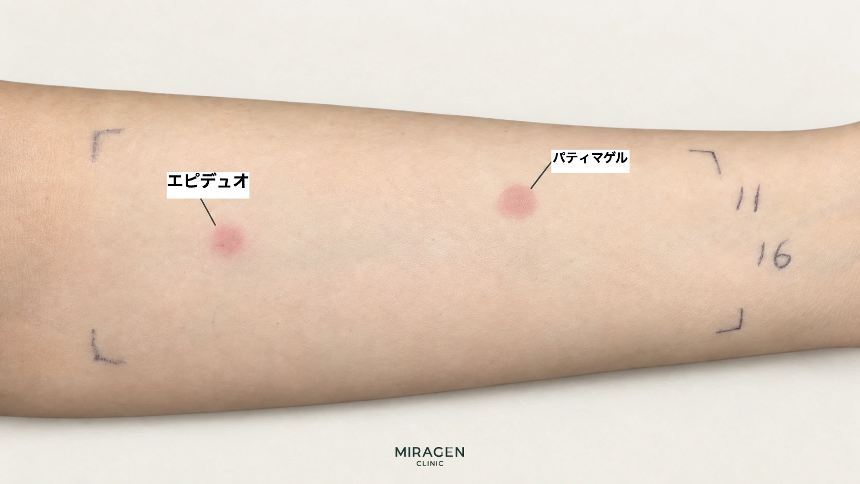腕のエピデュオゲルとファティマゲル塗布部位に現れた赤い皮膚反応を示した編集画像