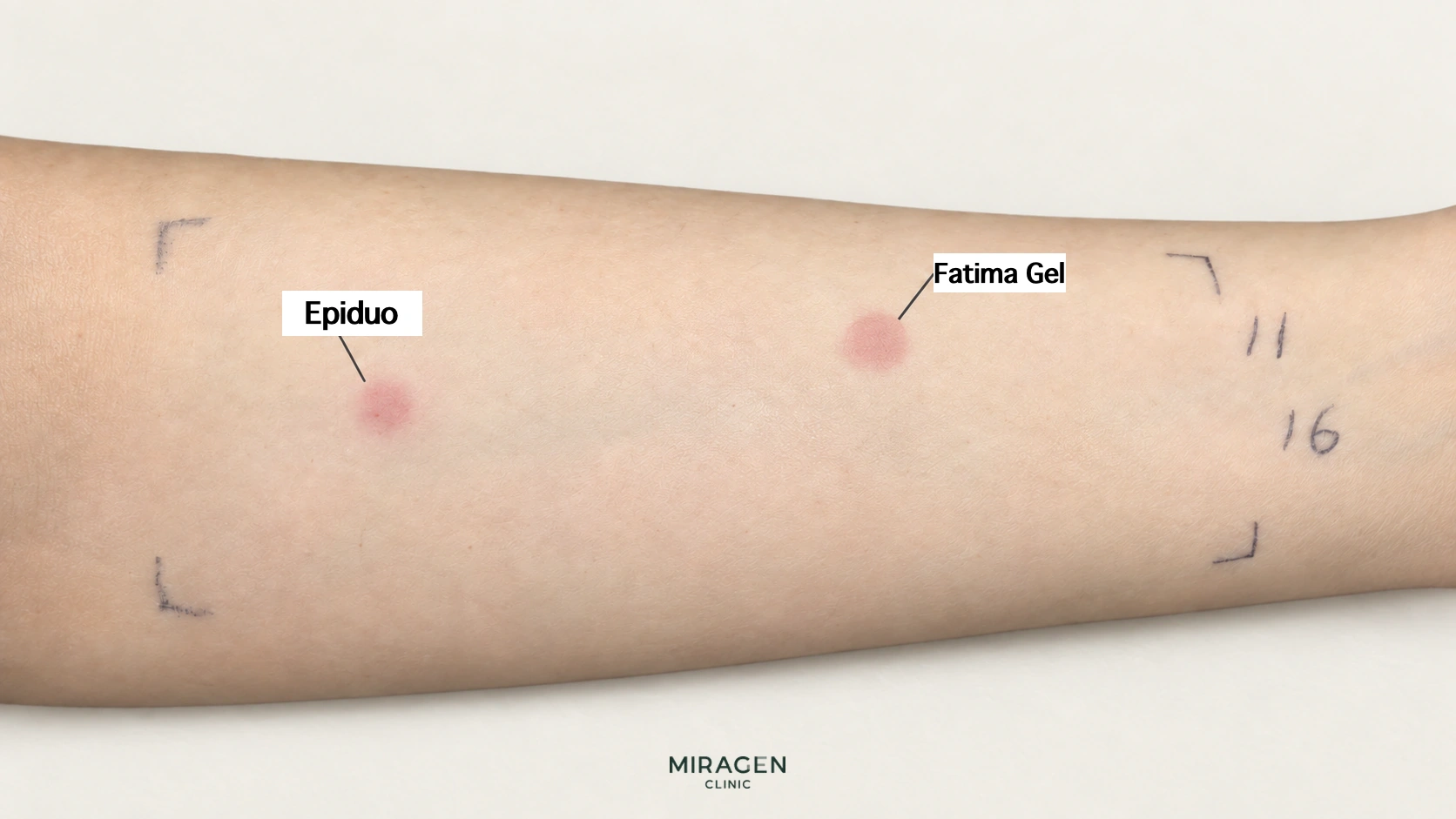 ภาพแก้ไขแสดงผิวแดงที่ตำแหน่งทา Epiduo Gel และ Fatima Gel บนแขน