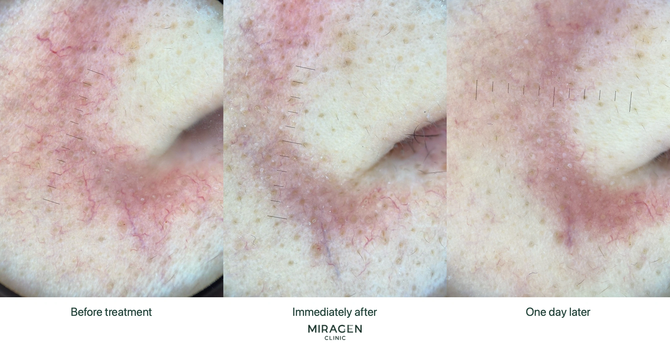 Polarized dermoscopy photos of vessels around the nose before the Excel V procedure, immediately after, and one day later, comparing results