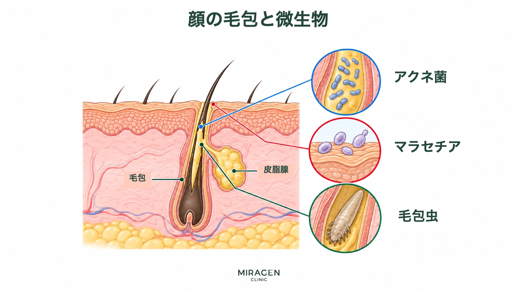 顔の皮膚の毛包と皮脂腺の構造、アクネ菌とマラセチアおよび毛包虫の様子を拡大して示す模式図