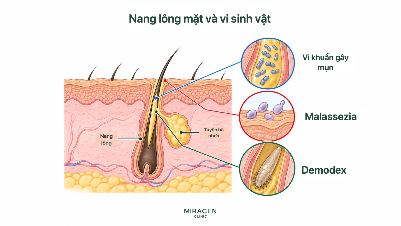 Sơ đồ phóng đại nang lông và tuyến bã trên mặt cùng vi khuẩn gây mụn, Malassezia và Demodex