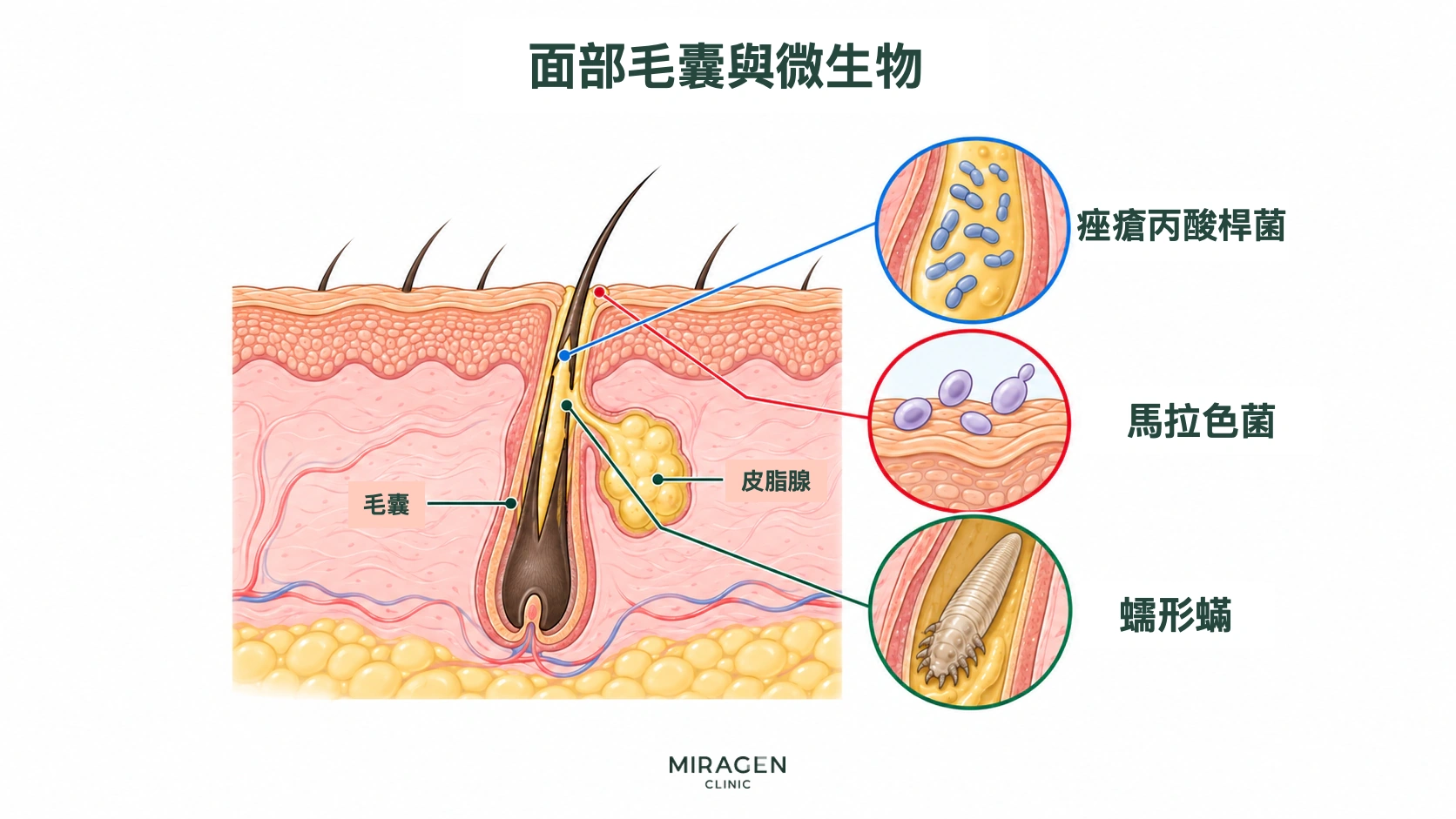 顯示臉部毛囊、皮脂腺,以及痤瘡丙酸桿菌、馬拉色菌和蠕形蟎的放大結構示意圖