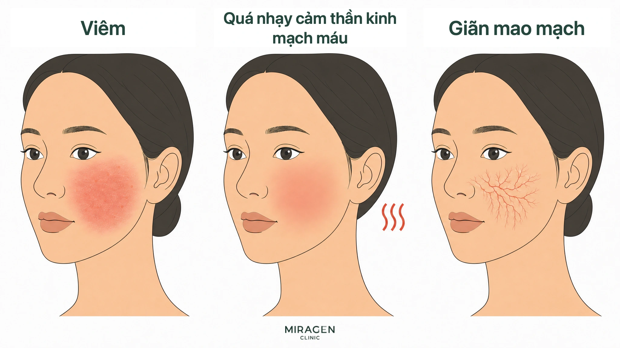 Minh họa y khoa so sánh trên cùng một khuôn mặt ba nguyên nhân gây đỏ: viêm, tăng nhạy cảm thần kinh-mạch máu và giãn mao mạch