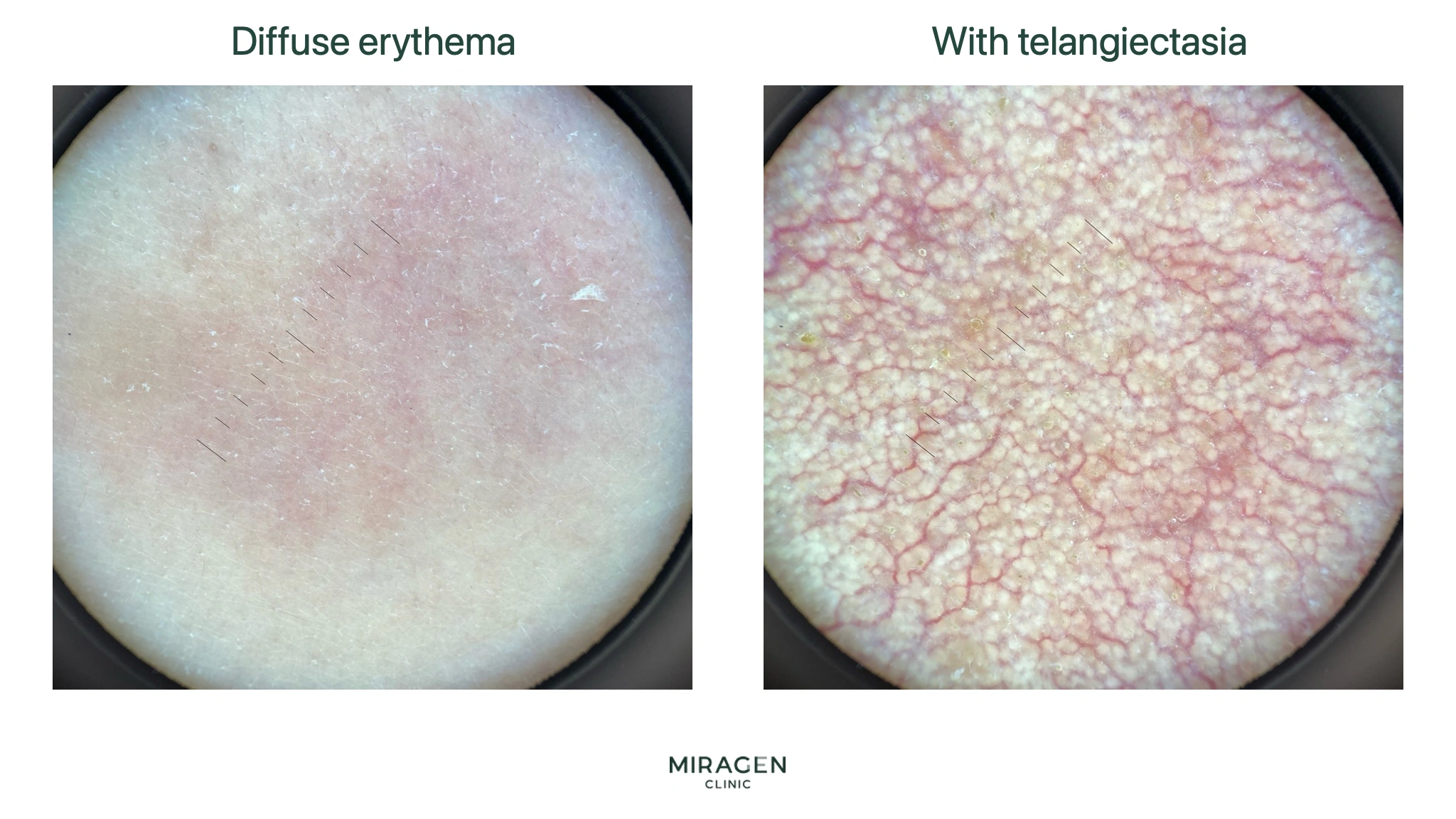 Photo comparing diffuse erythema with no visible fine vessels and telangiectasia with a distinct red vascular network on polarized dermoscopy