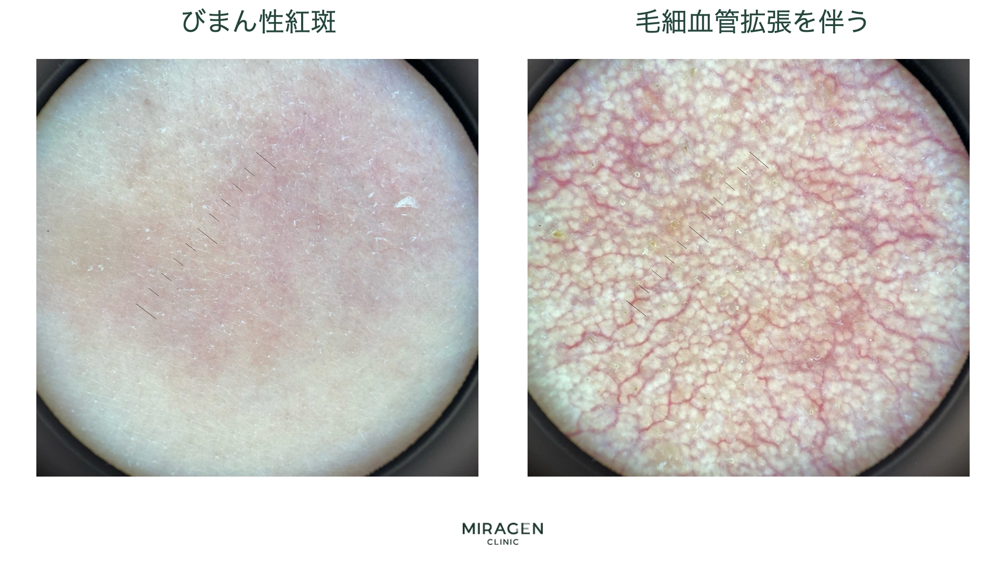 偏光ダーモスコピーで、細い血管が見えないびまん性紅斑と、赤い血管網が明瞭な毛細血管拡張症を比較した写真