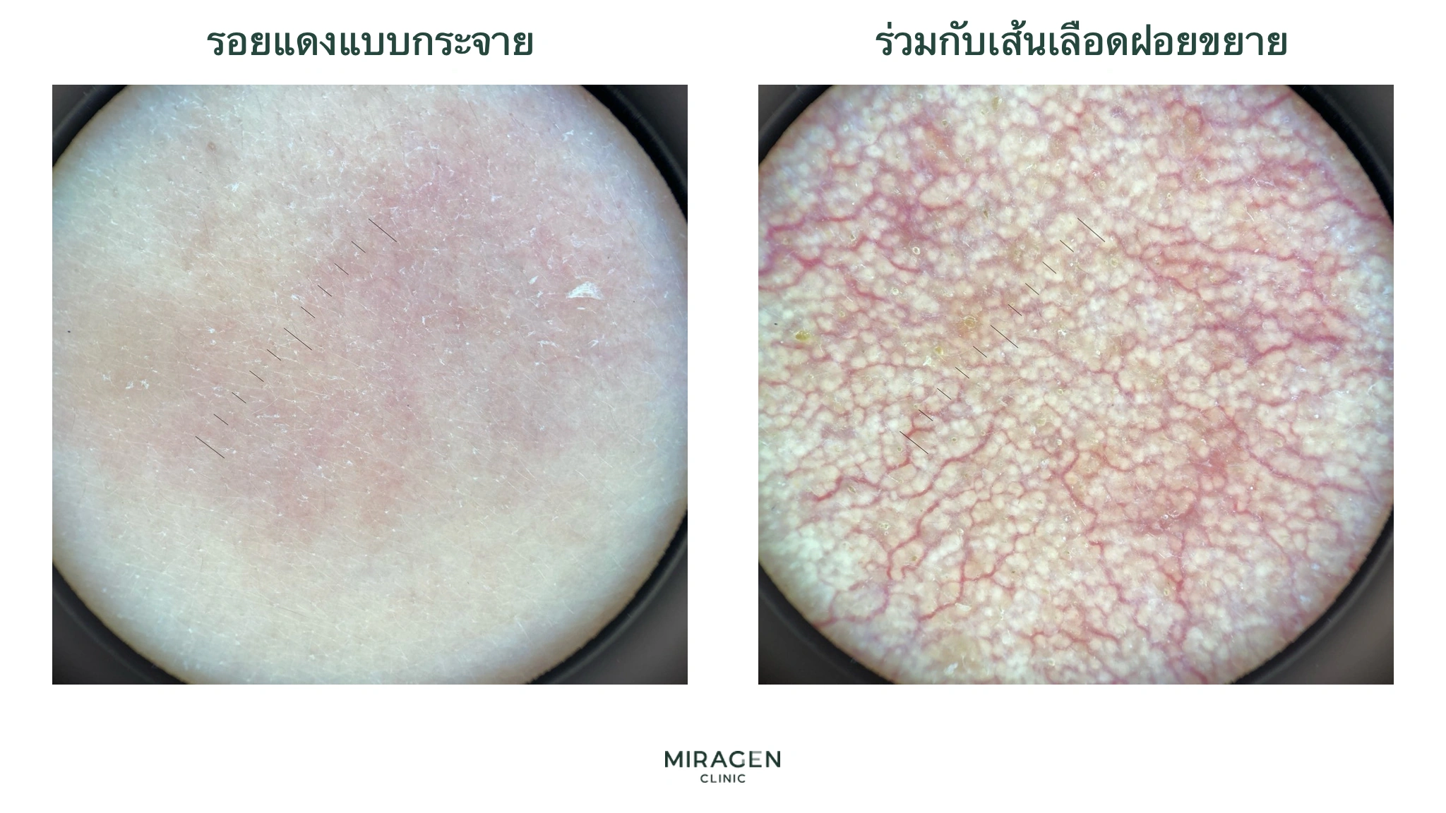 ภาพเปรียบเทียบจากเดอร์มาโตสโคปแบบโพลาไรซ์ระหว่างผิวแดงกระจายที่ไม่เห็นหลอดเลือดเล็กกับภาวะหลอดเลือดฝอยขยายตัวที่เห็นร่างแหหลอดเลือดแดงชัด