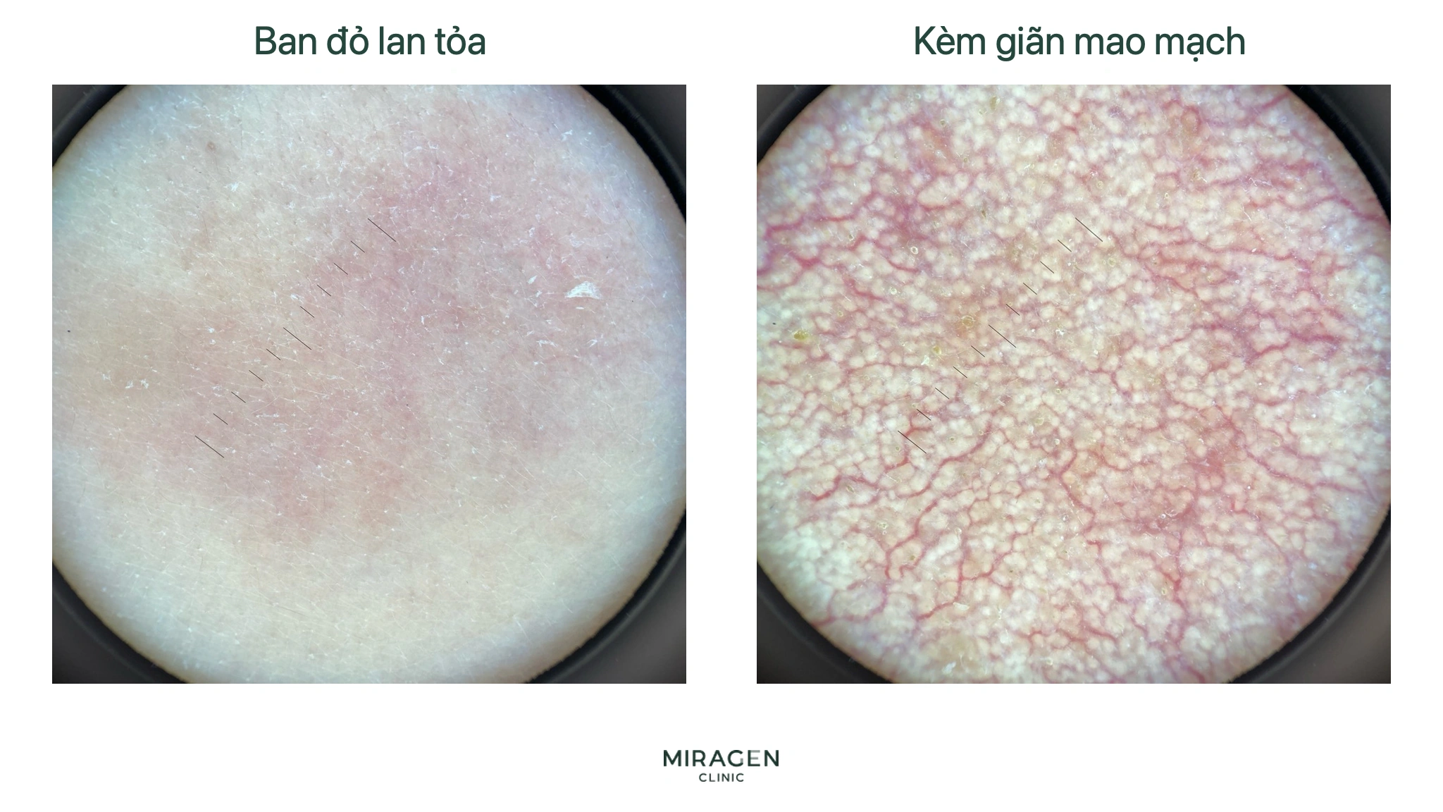 Ảnh soi da phân cực so sánh ban đỏ lan tỏa không thấy mạch nhỏ với giãn mao mạch có mạng lưới mạch đỏ rõ