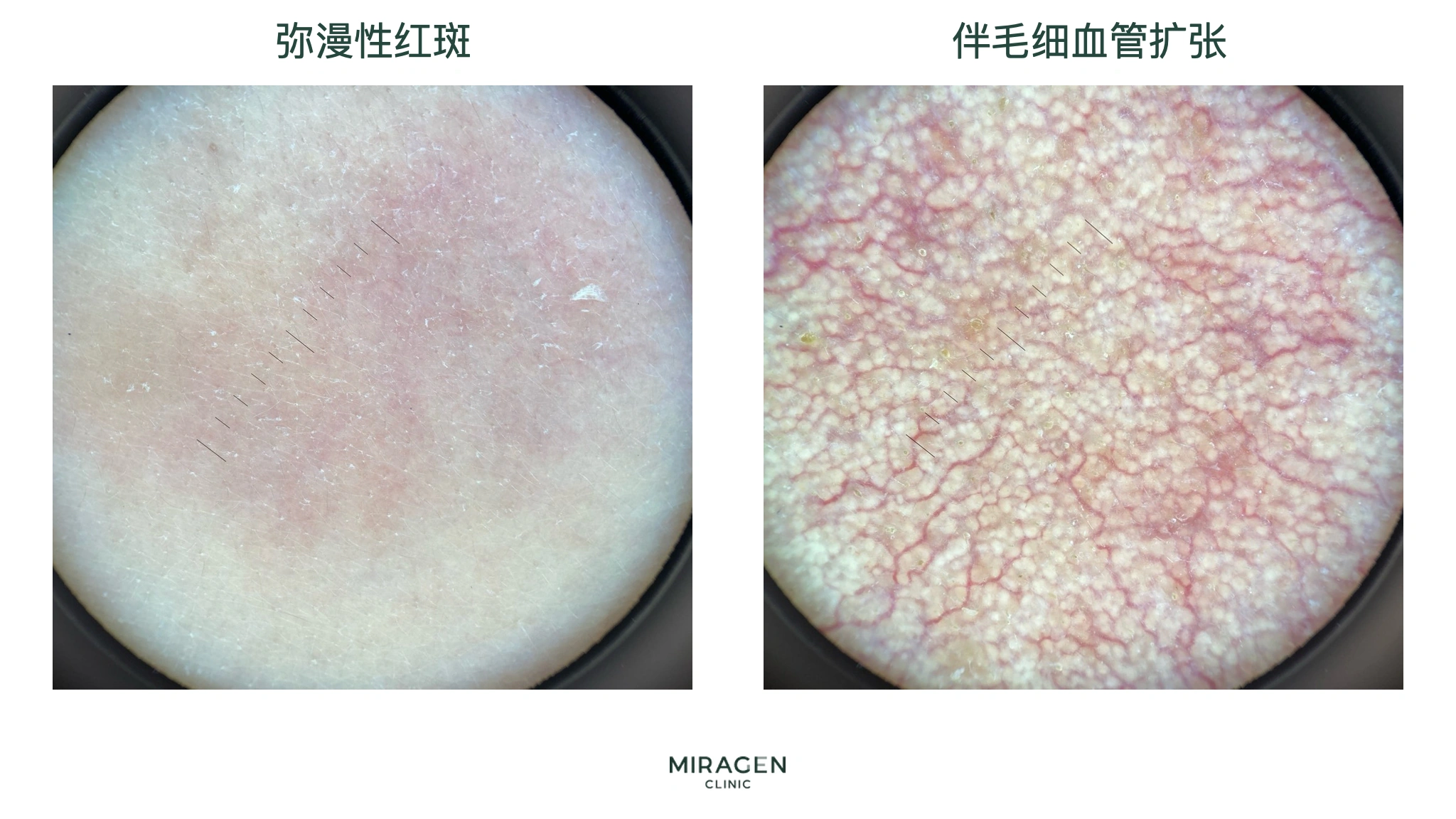 对比照片:偏振皮肤镜下不见细小血管的弥漫性红斑,与红色血管网清晰可见的毛细血管扩张