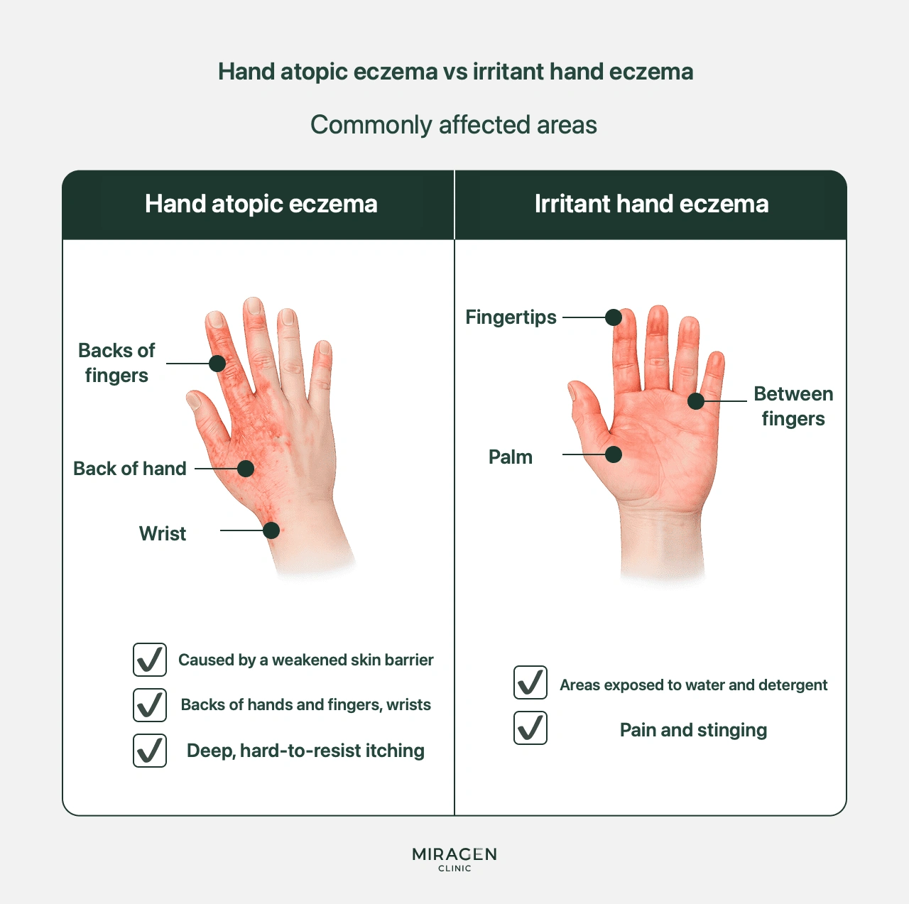 How to tell back-of-hand atopic dermatitis from housewife’s eczema