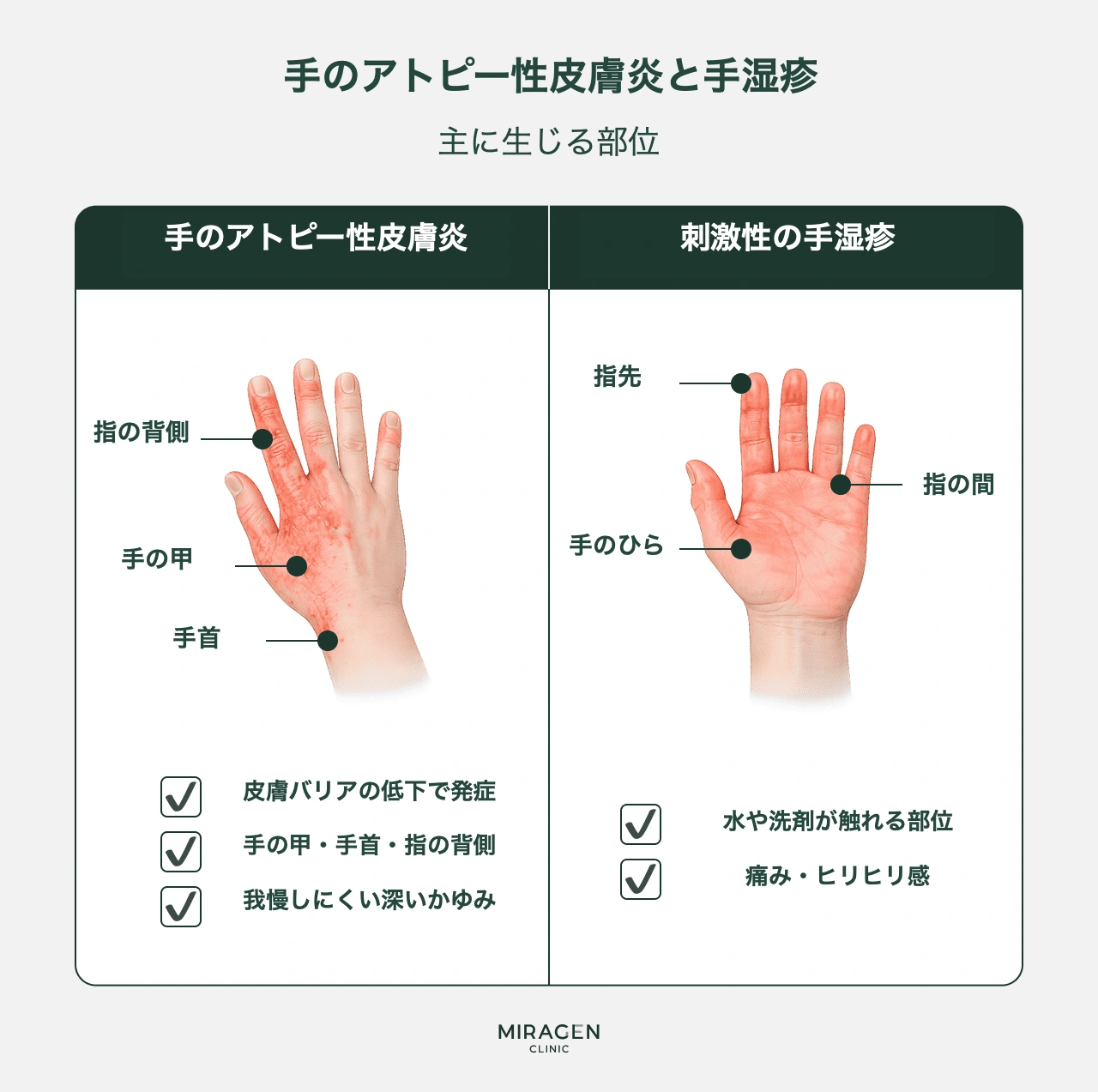 手の甲のアトピー性皮膚炎と主婦湿疹の区別法