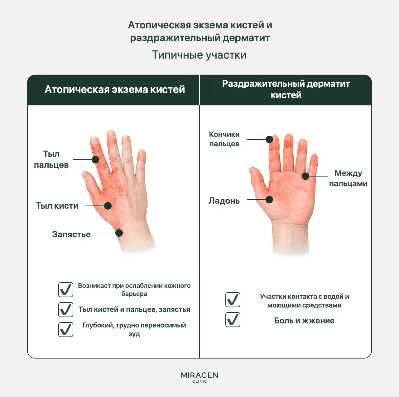 Сравнение атопического дерматита тыльной стороны кистей и раздражительной бытовой экземы