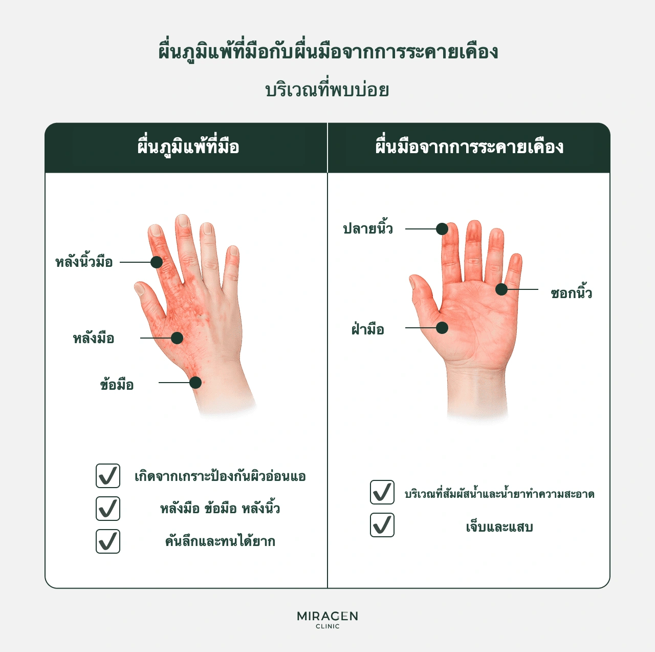 ภาพอธิบายวิธีแยกผื่นภูมิแพ้ผิวหนังหลังมือกับผื่นระคายเคืองจากงานบ้าน