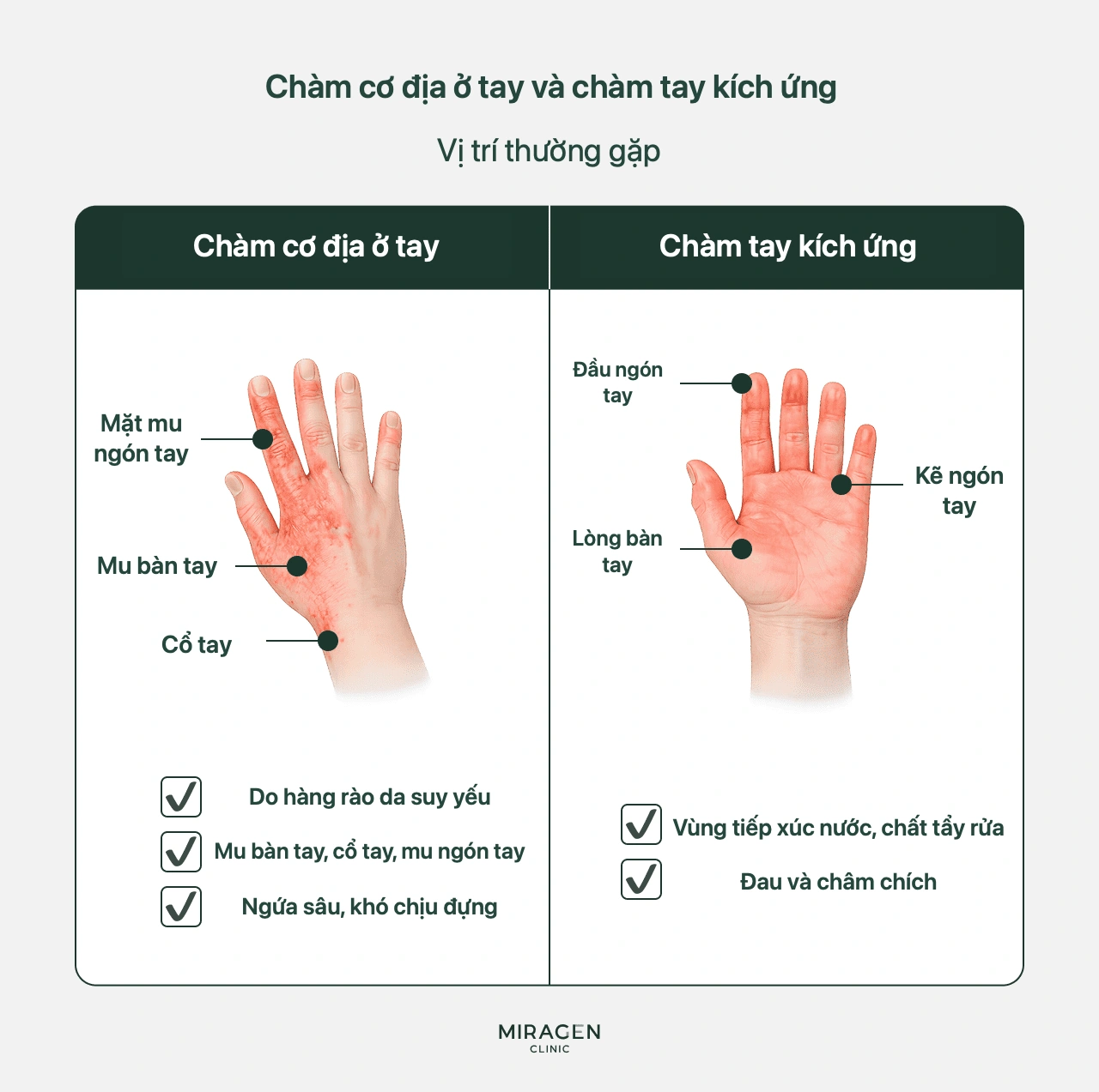 Hình hướng dẫn phân biệt viêm da cơ địa ở mu bàn tay với chàm bàn tay do tiếp xúc