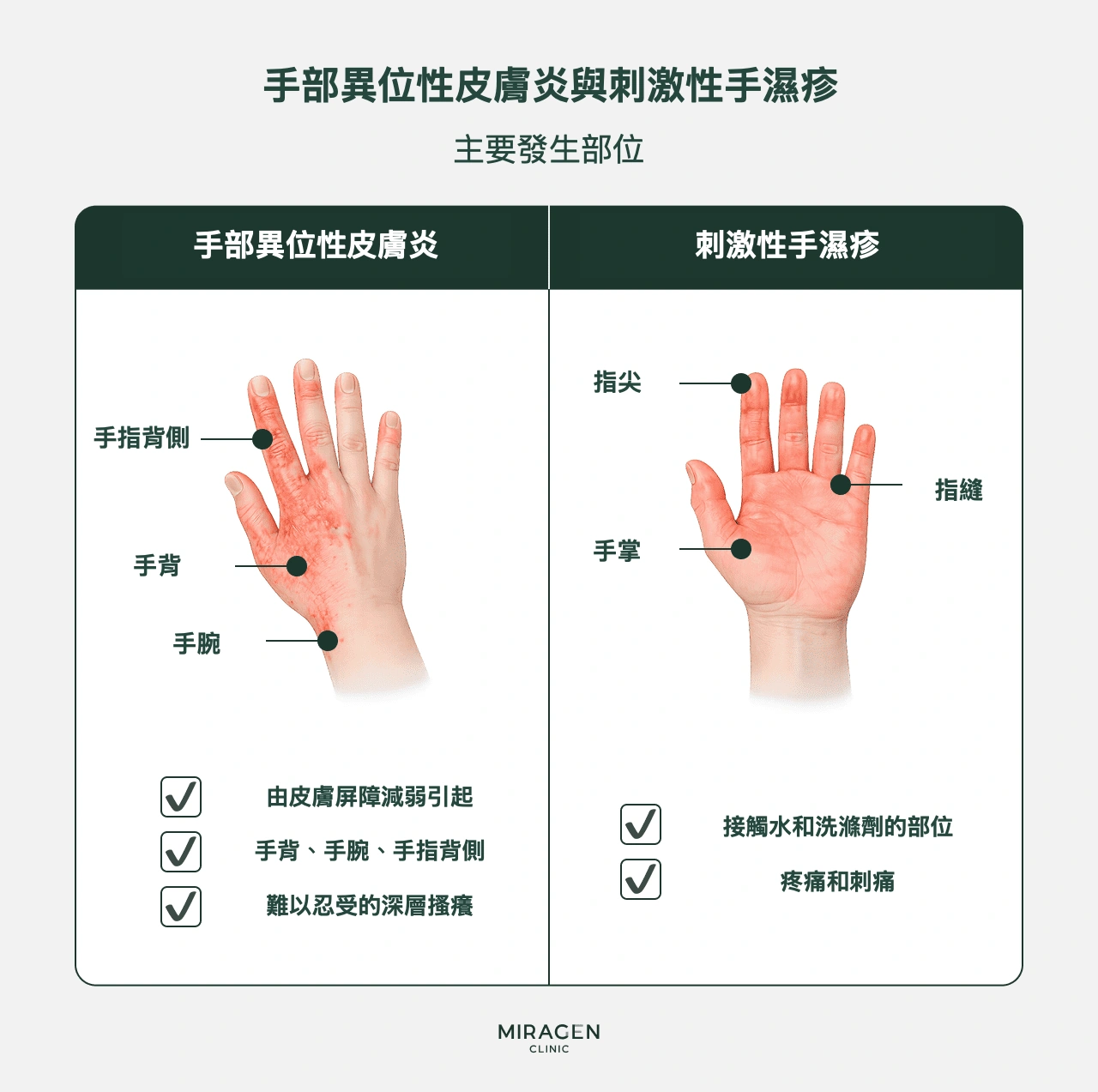 手背異位性皮膚炎與刺激性手濕疹的區別示意圖