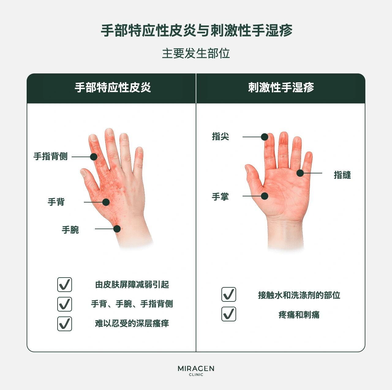 手背特应性皮炎与刺激性手湿疹的区别示意图