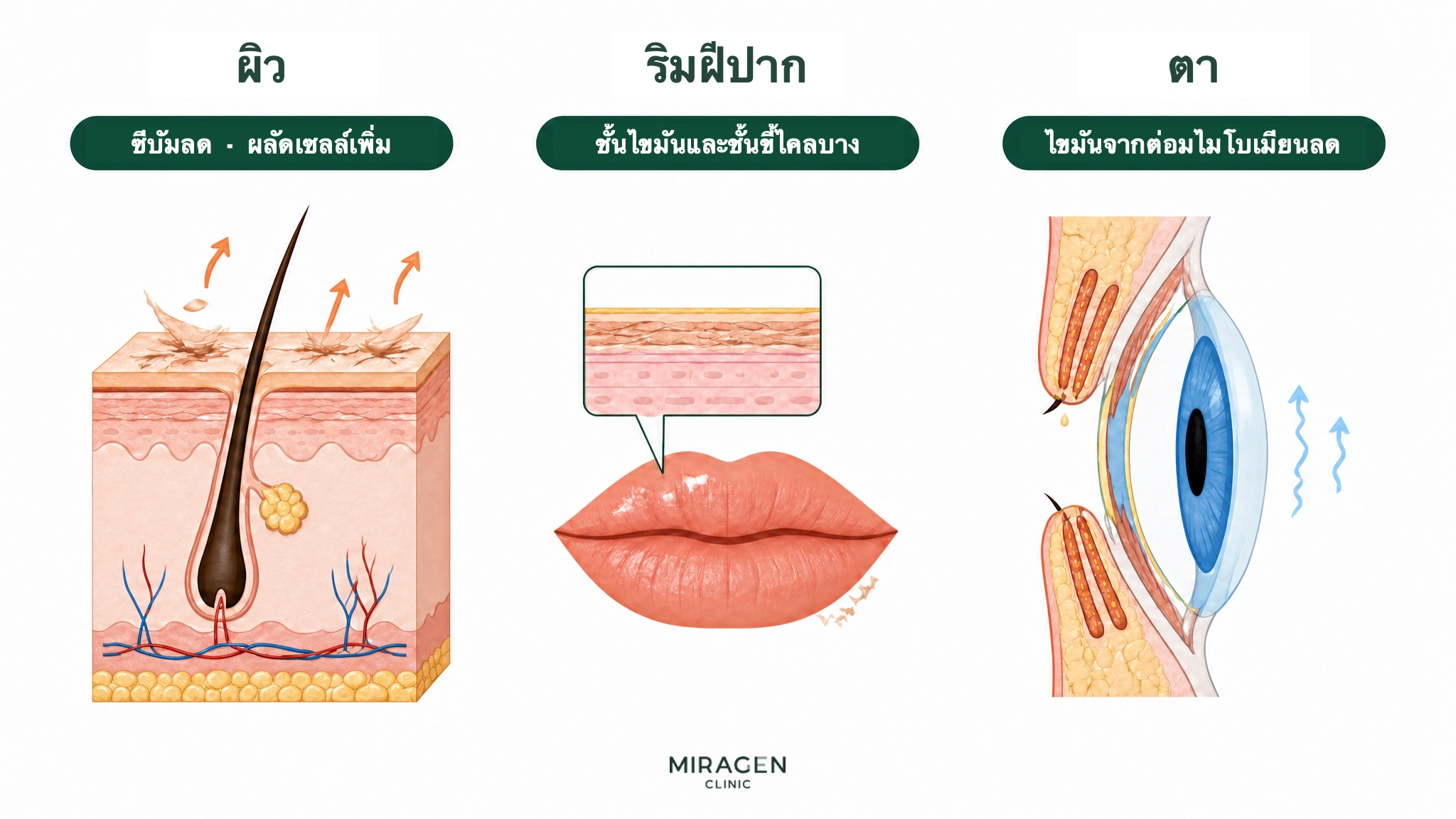 ภาพอธิบายผิวแห้งจากไขมันผิวลดและเซลล์ผิวหลุดมากขึ้น ริมฝีปากแห้งเพราะชั้นไขมันและผิวบาง และตาแห้งเพราะต่อมไมโบเมียนหลั่งไขมันลดลงหลังใช้ไอโซตินอน
