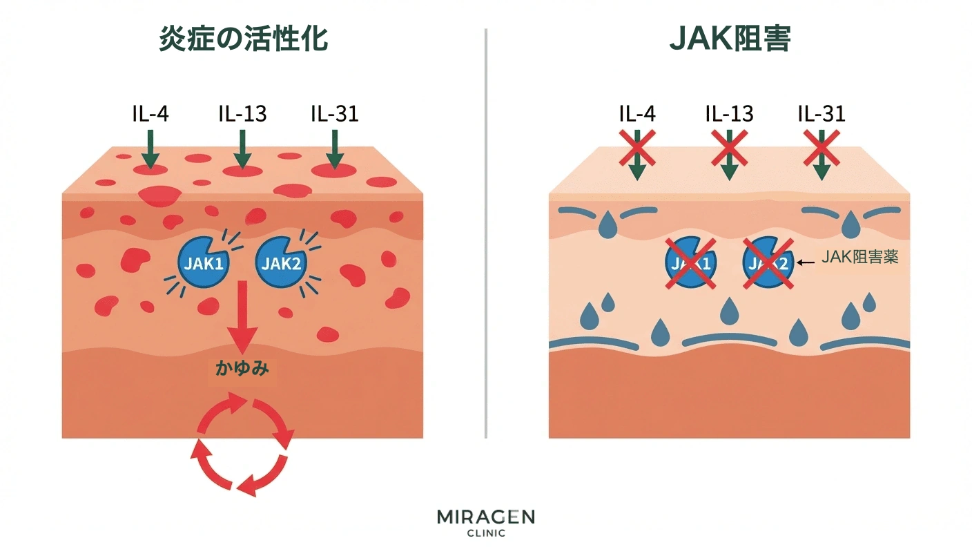 ルティニブ軟膏とオプゼルラの主成分であるルキソリチニブが JAK1 と JAK2 を阻害し、アトピーのかゆみと炎症シグナルを遮断する作用機序を示した医療イラスト