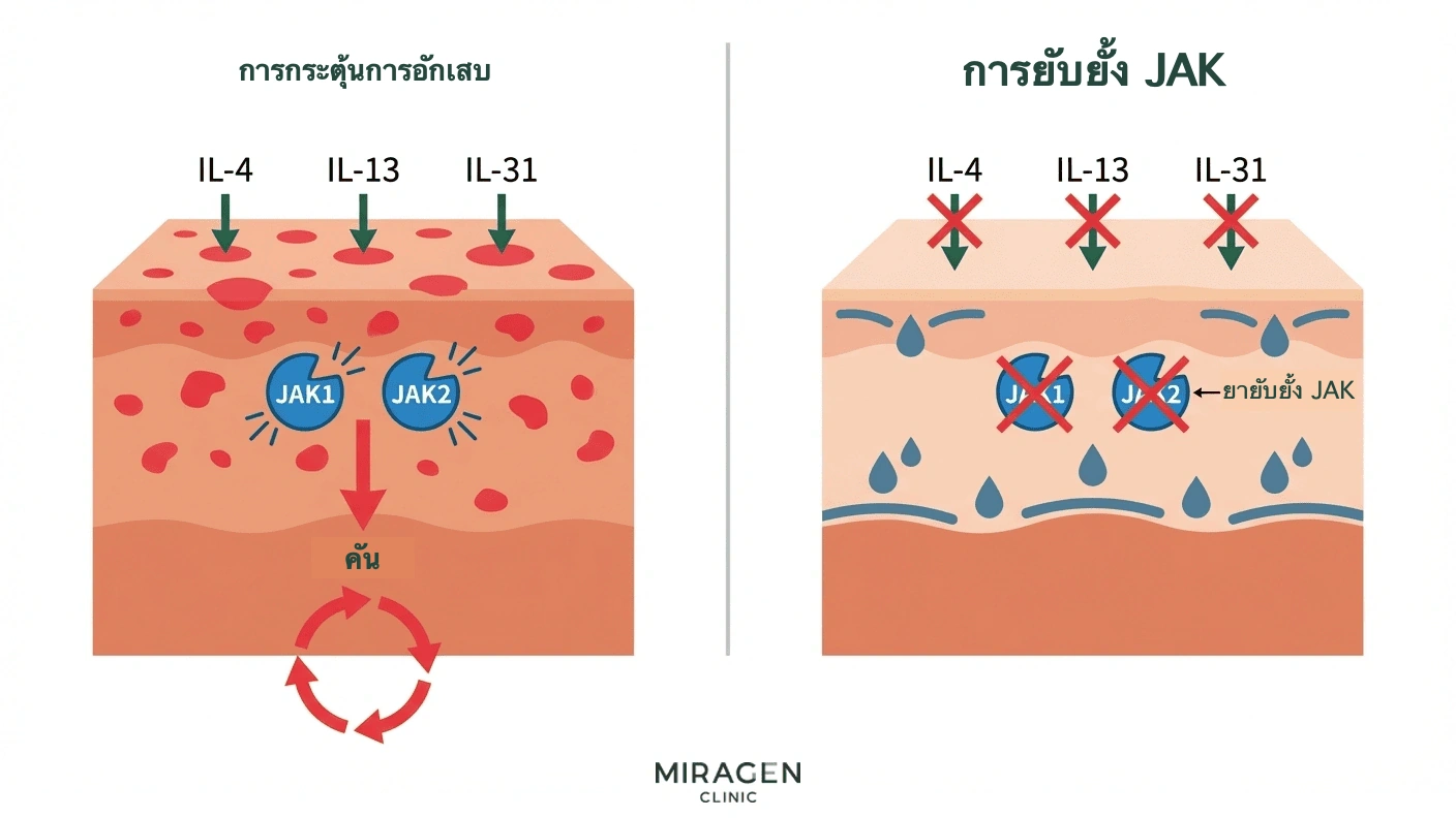 ภาพการแพทย์แสดงแอนซุปโกยับยั้งเส้นทาง JAK เพื่อลดการส่งสัญญาณอักเสบจากเซลล์ภูมิคุ้มกันและลดอาการคันกับการอักเสบ