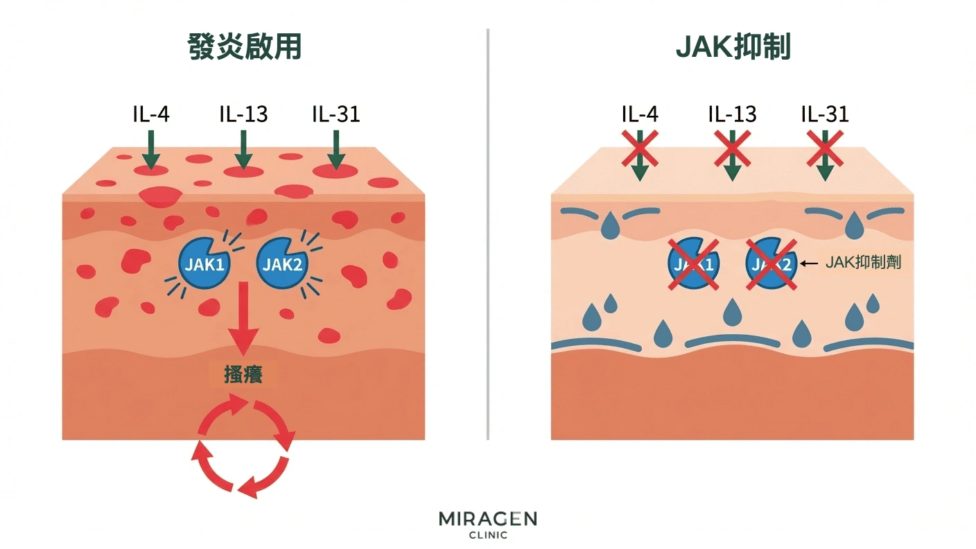 醫學插圖展示 Anzupgo 乳膏抑制 JAK 通路的機制：阻斷免疫細胞的發炎訊號傳遞，減輕手部濕疹與異位性皮膚炎相關的搔癢和發炎