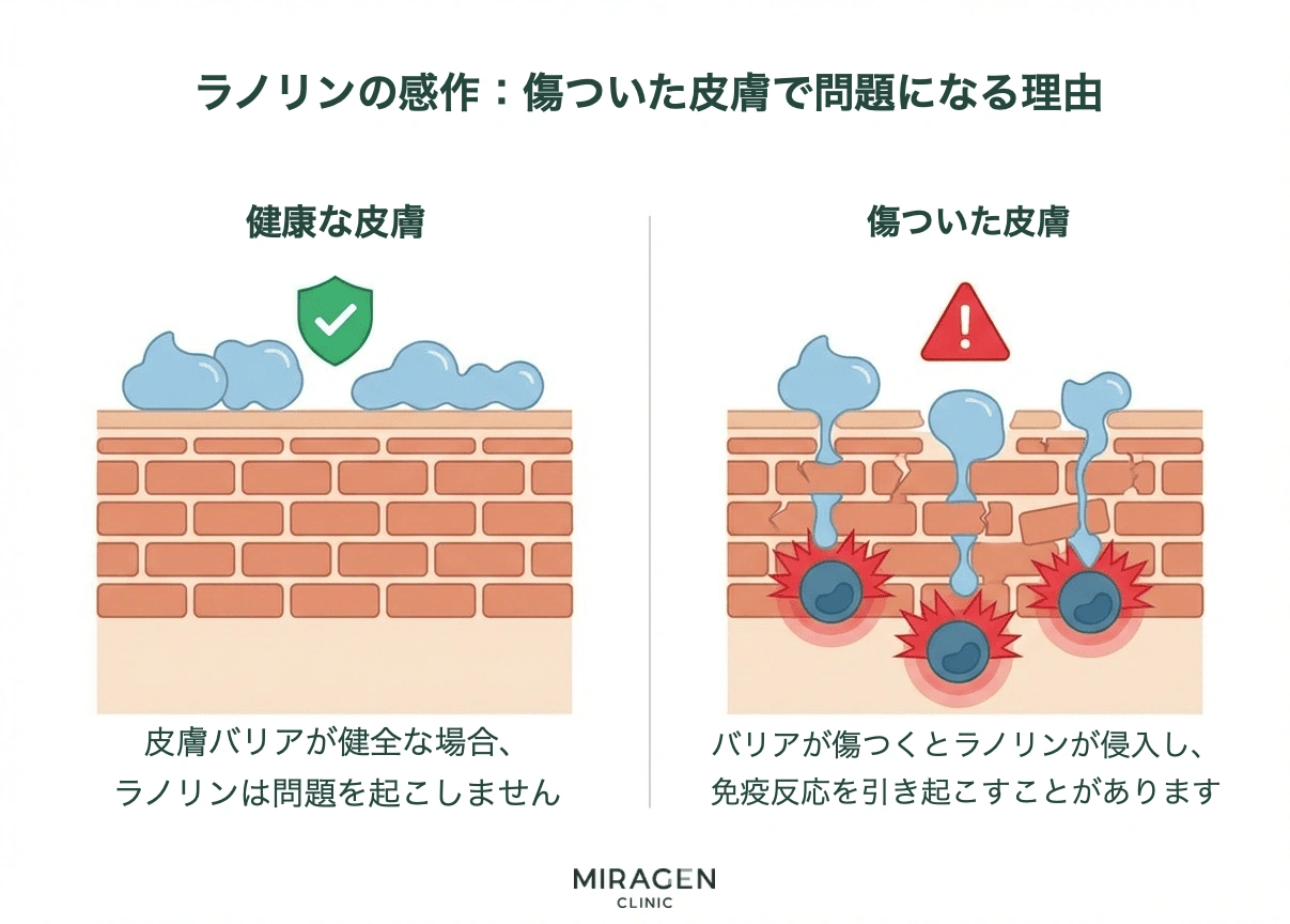 健康な肌と損傷した肌でラノリン感作が起こるメカニズムを比較した肌バリア断面のイラスト — バリアが健全であればラノリンは浸透できず、損傷していると免疫反応を誘発する様子