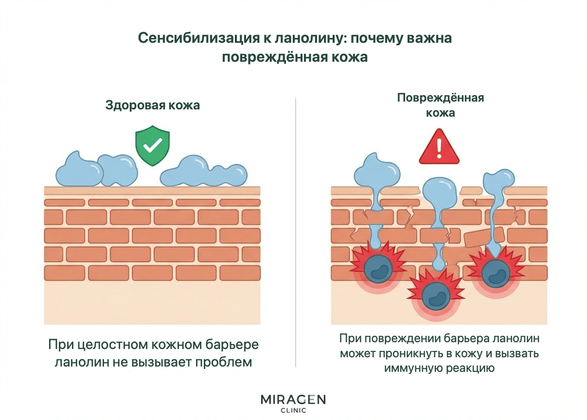 Сравнительная схема показывает, как целый кожный барьер препятствует проникновению ланолина, а поврежденный позволяет ему вызвать иммунную реакцию