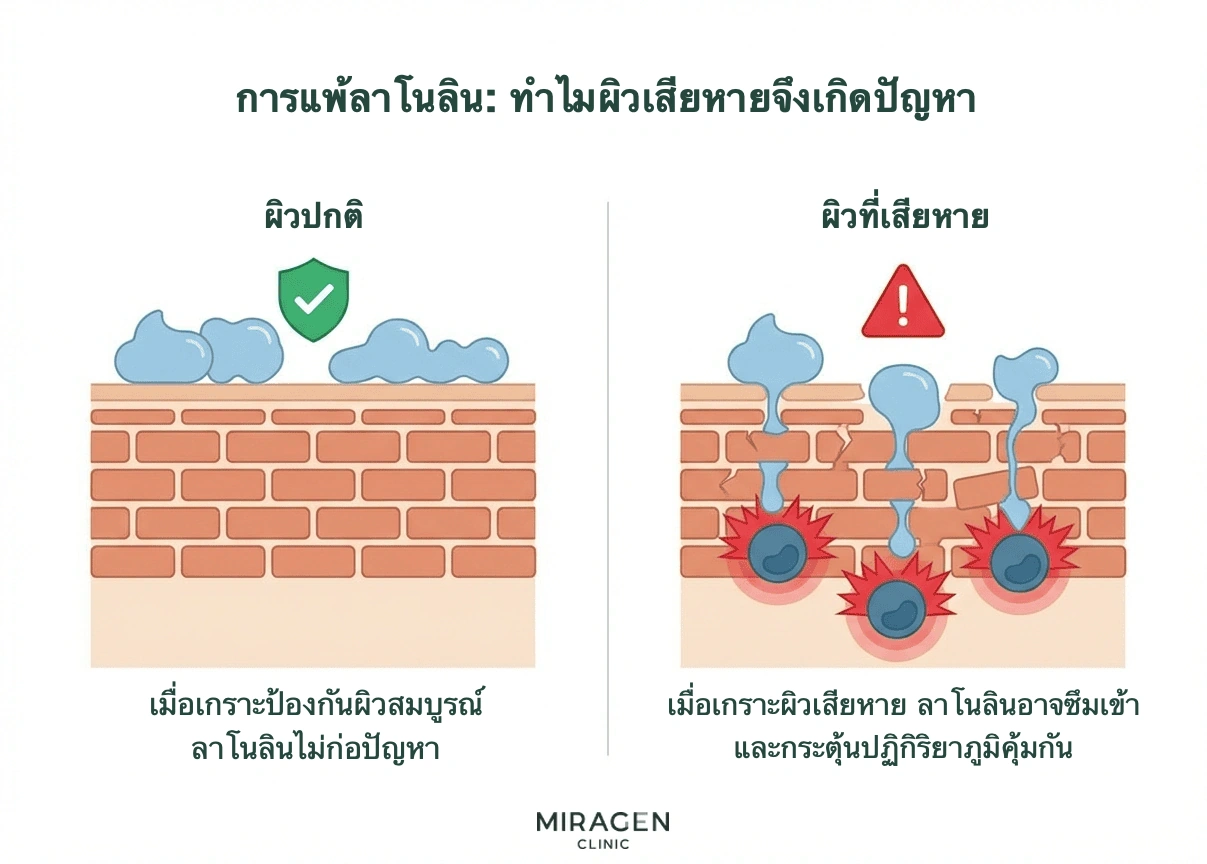 ภาพตัดขวางเกราะป้องกันผิวเปรียบเทียบกลไกการไวต่อลาโนลินบนผิวแข็งแรงซึ่งไม่ซึมผ่าน กับผิวเสียหายที่ลาโนลินผ่านไปกระตุ้นภูมิคุ้มกันได้