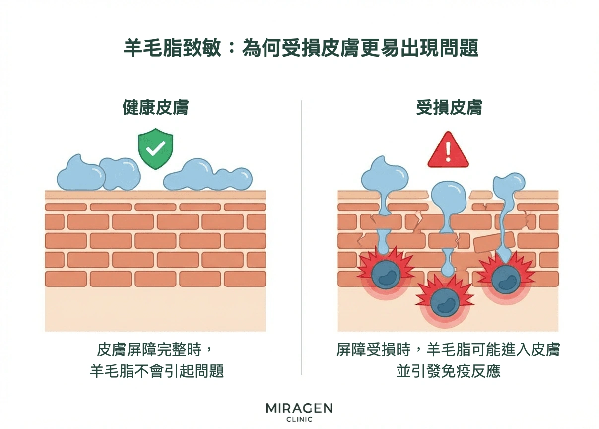 皮膚屏障橫截面圖比較健康與受損皮膚中羊毛脂致敏機制：屏障完整時不易進入，受損時則可能引發免疫反應
