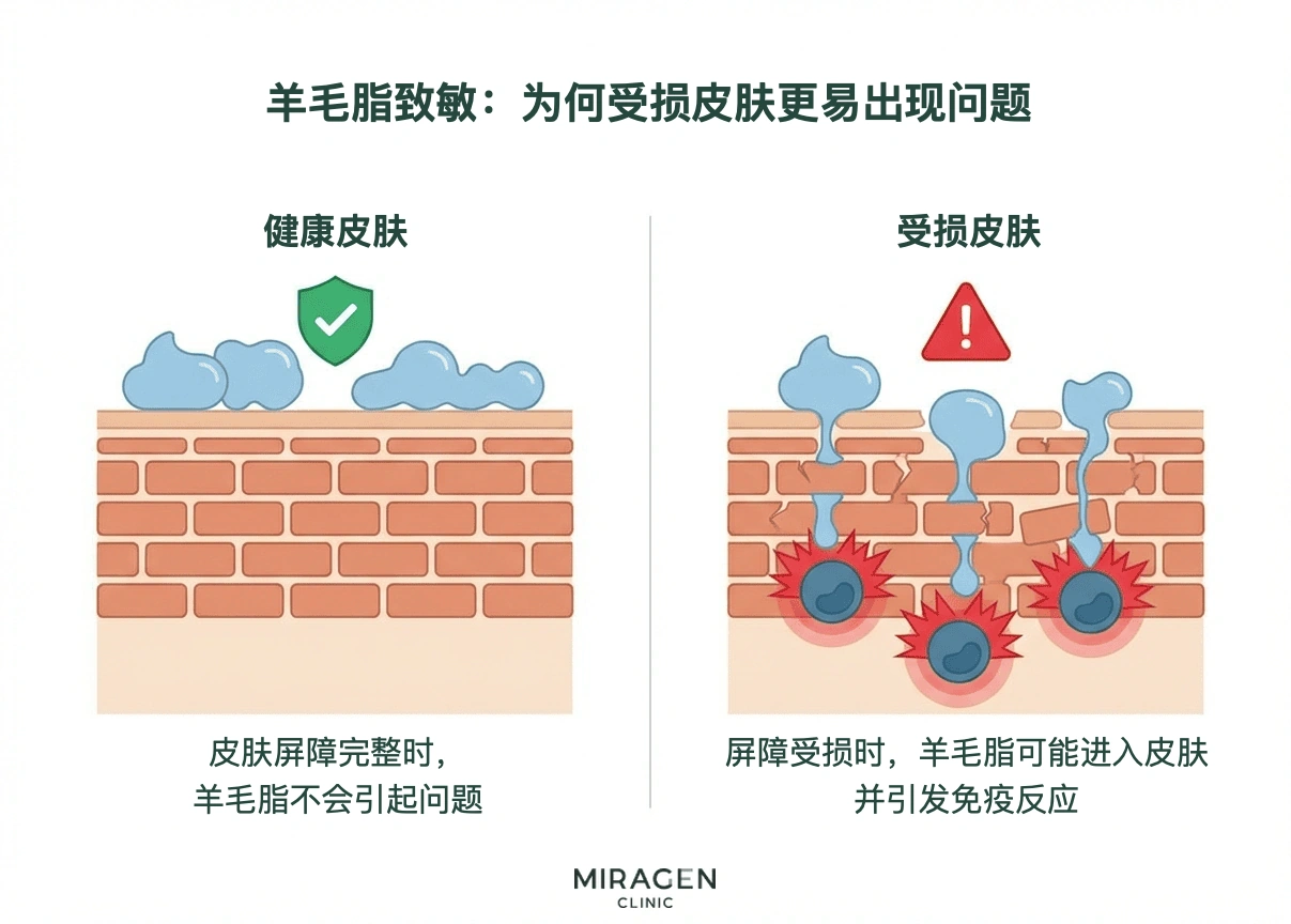 皮肤屏障横截面图比较健康与受损皮肤中羊毛脂致敏机制：屏障完整时不易进入，受损时则可能引发免疫反应
