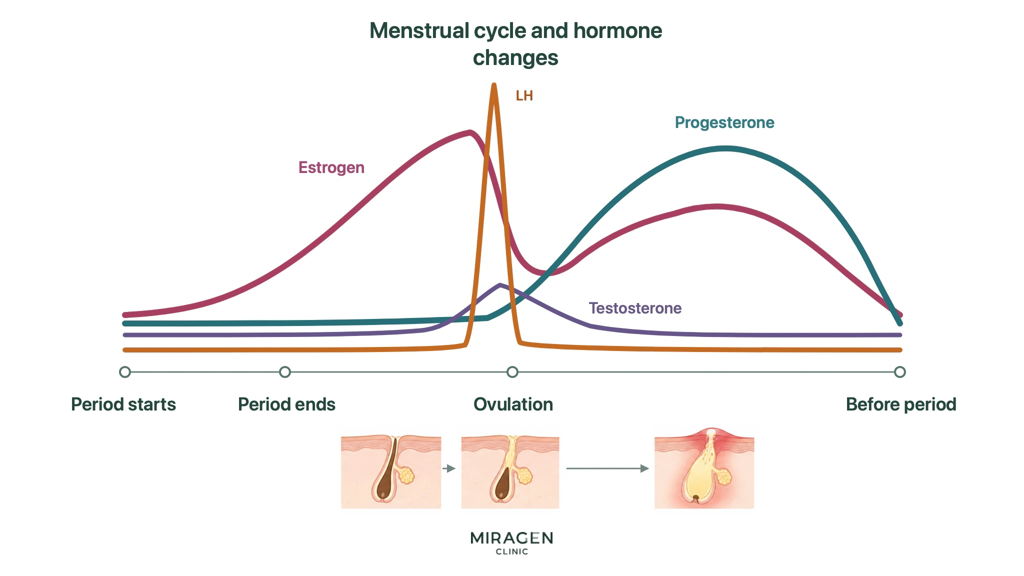 An illustration representing the hypothesis that changes in estrogen, progesterone, LH, and testosterone according to the menstrual cycle, along with pore clogging around ovulation, can lead to premenstrual acne.
