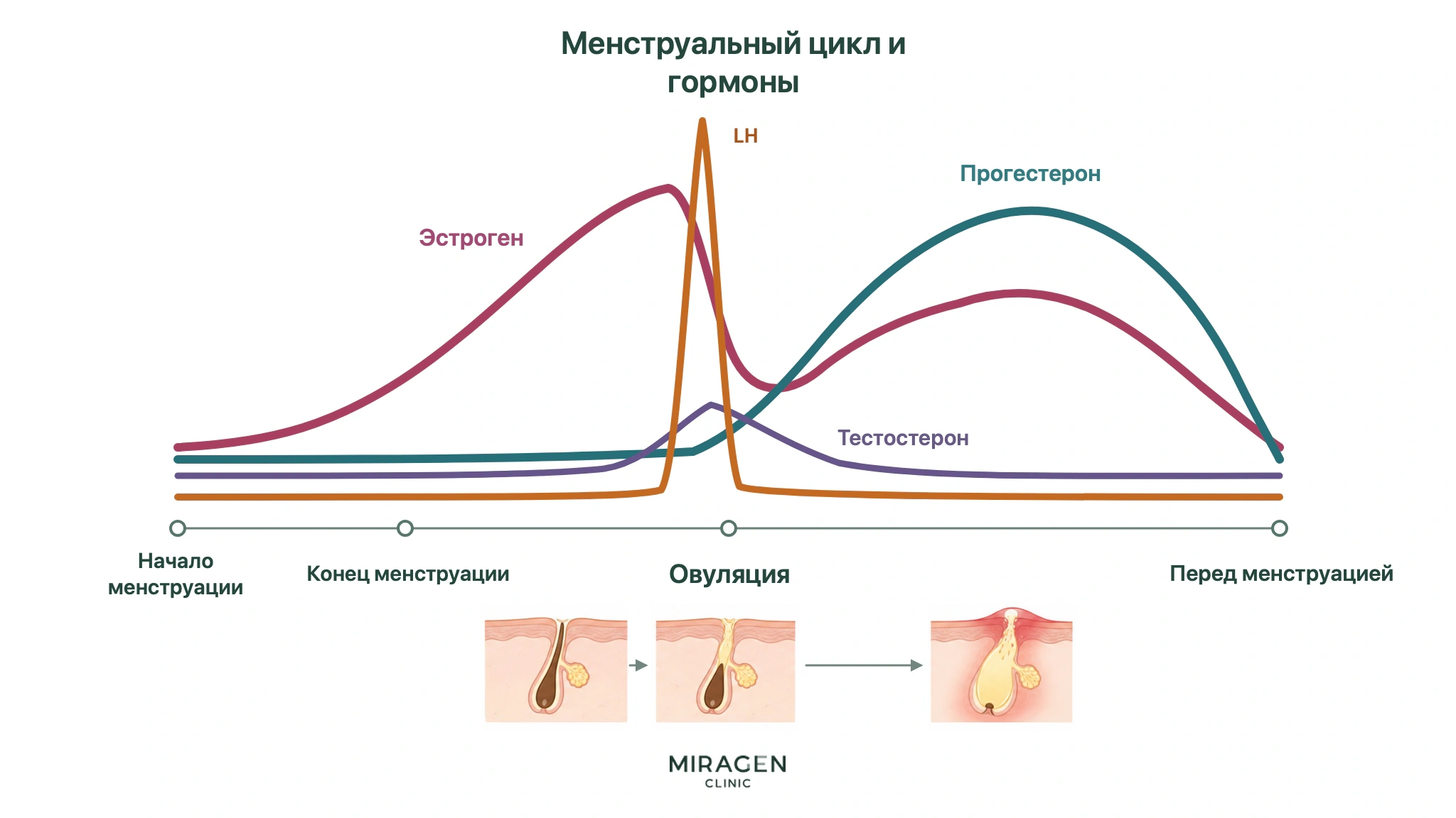 Схема показывает изменения эстрогена, прогестерона, ЛГ и тестостерона в цикле и гипотезу о том, что закупорка пор вокруг овуляции приводит к акне перед менструацией
