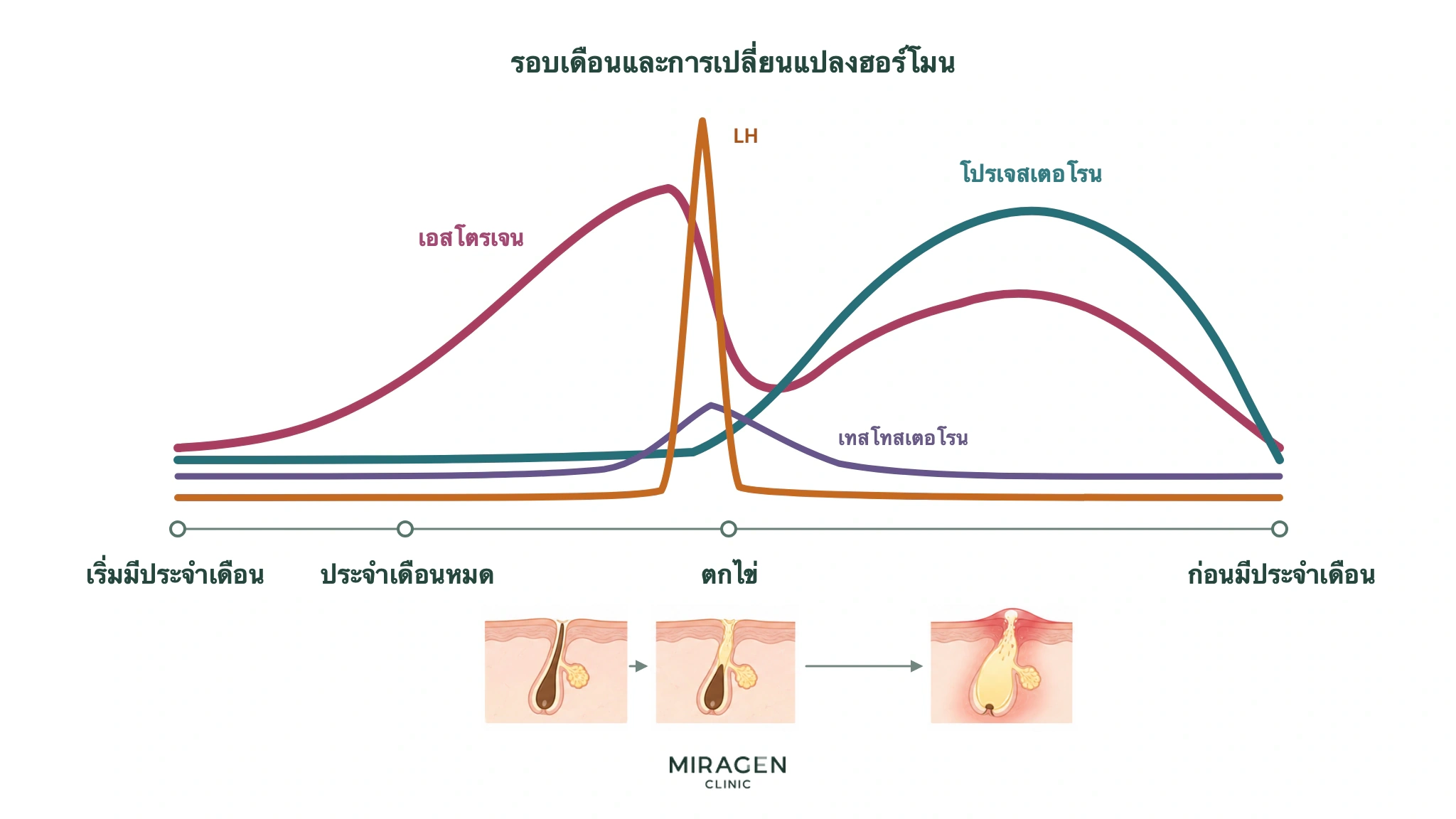 ภาพการเปลี่ยนแปลงของเอสโตรเจน โปรเจสเตอโรน LH และเทสโทสเตอโรนตามรอบเดือน พร้อมสมมติฐานว่ารูขุมขนอุดตันช่วงตกไข่อาจนำไปสู่สิวก่อนมีประจำเดือน