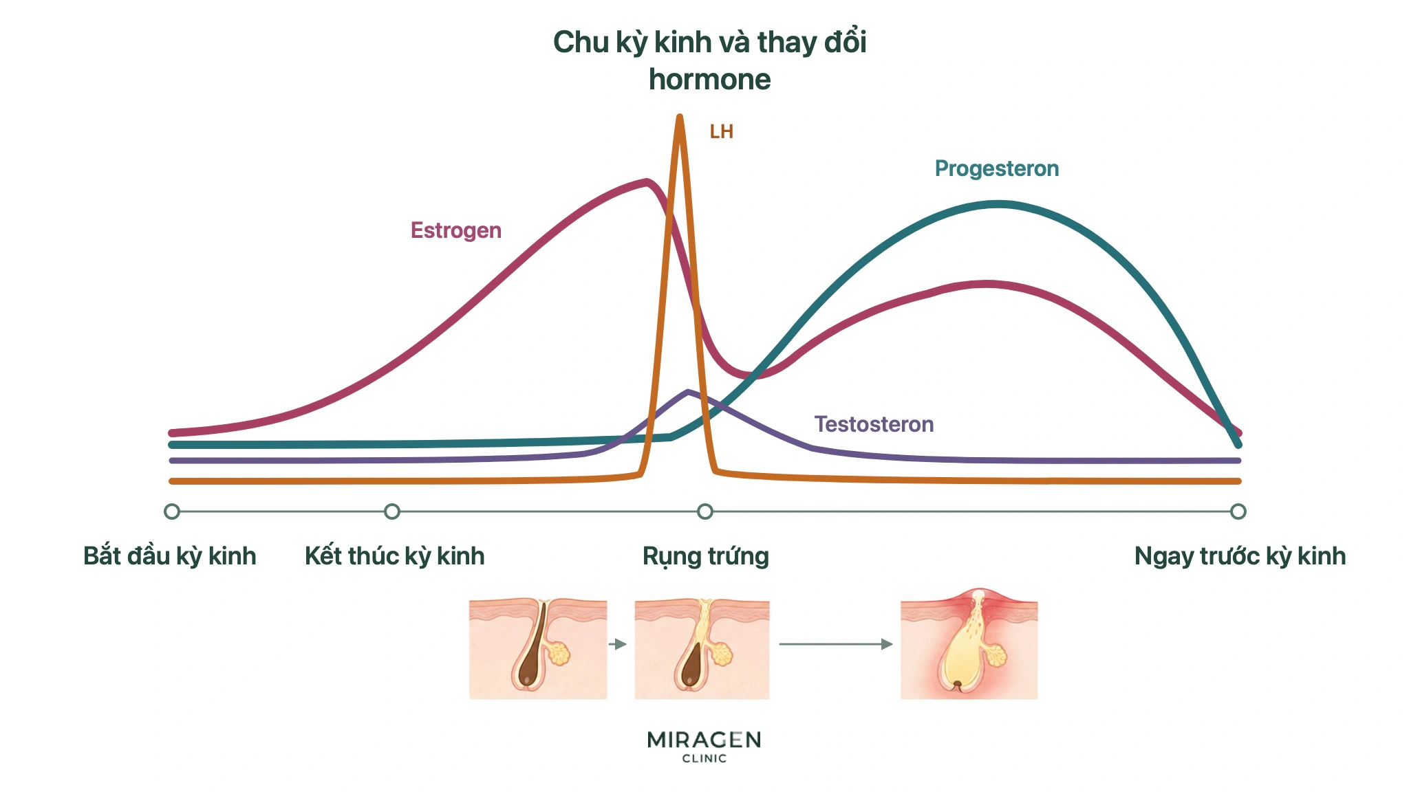 Sơ đồ biến động estrogen, progesterone, LH và testosterone trong chu kỳ kinh, cùng giả thuyết lỗ chân lông bị bít quanh thời điểm rụng trứng dẫn đến mụn trước kỳ kinh