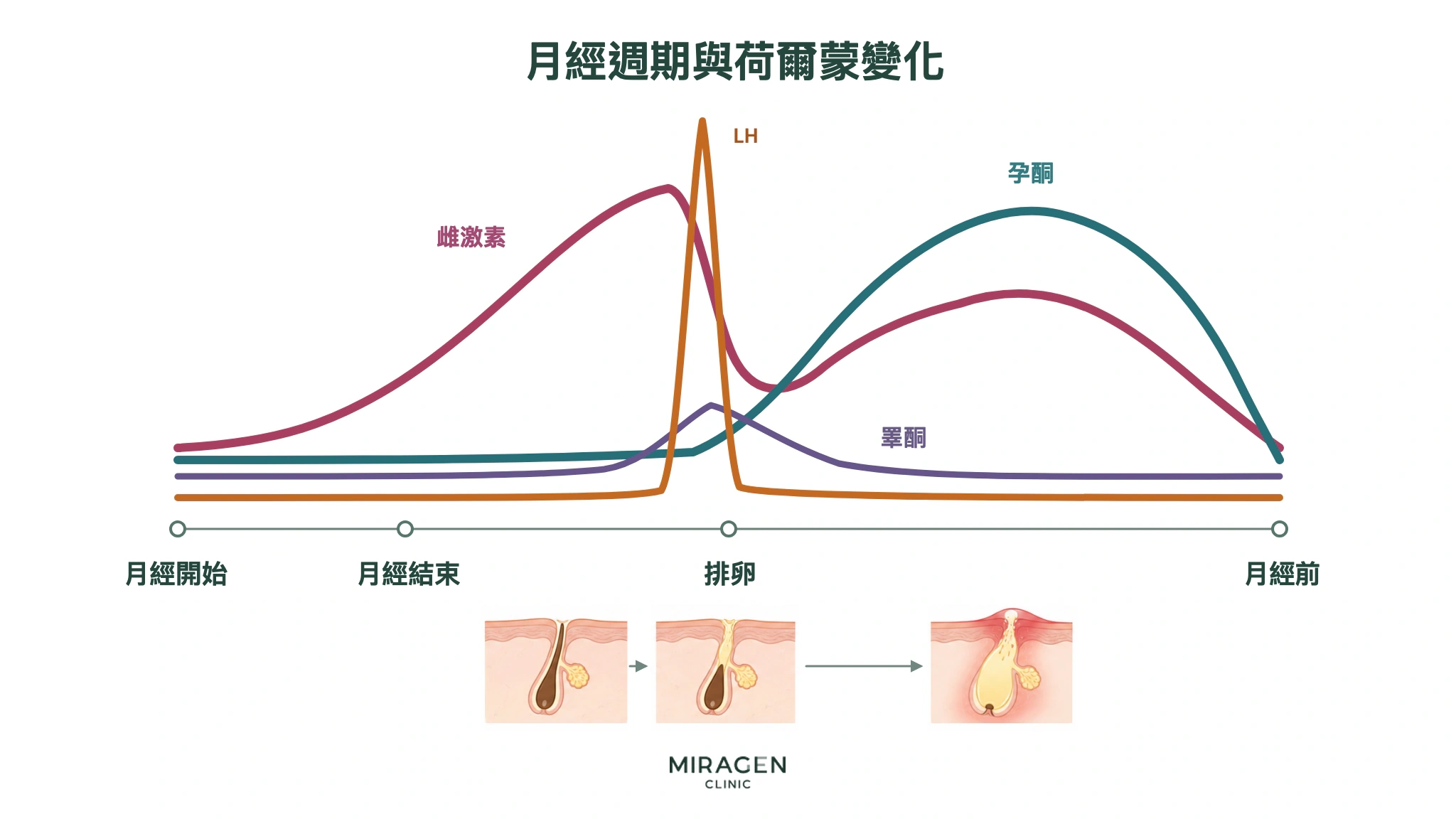 說明月經週期中雌激素、黃體素、LH 和睪酮變化的圖表,並提出排卵期毛孔堵塞可能在經前發展為痤瘡的假設