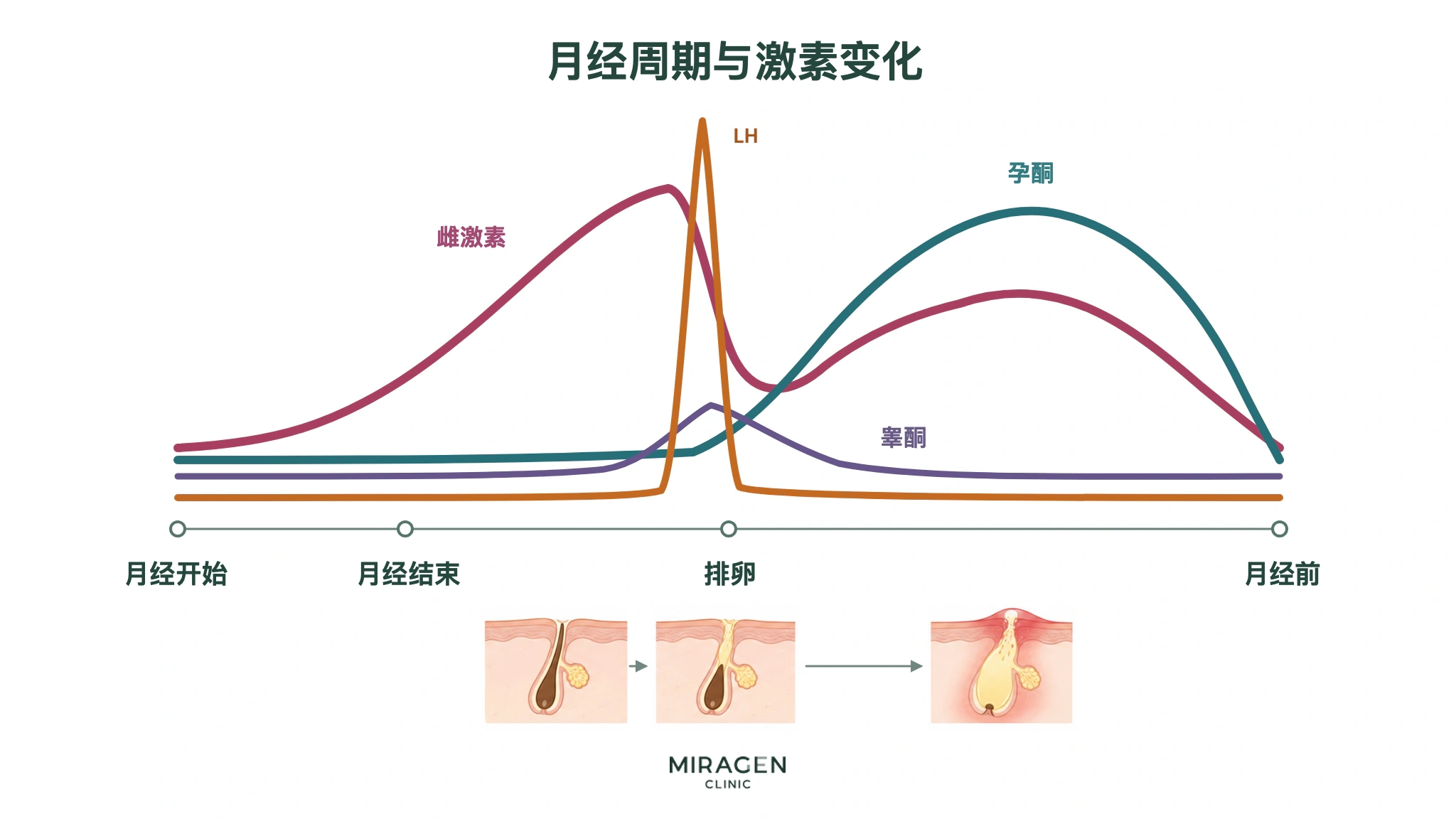 说明月经周期中雌激素、孕激素、LH 和睾酮变化的图表，并提出排卵期毛孔堵塞可能在经前发展为痤疮的假设