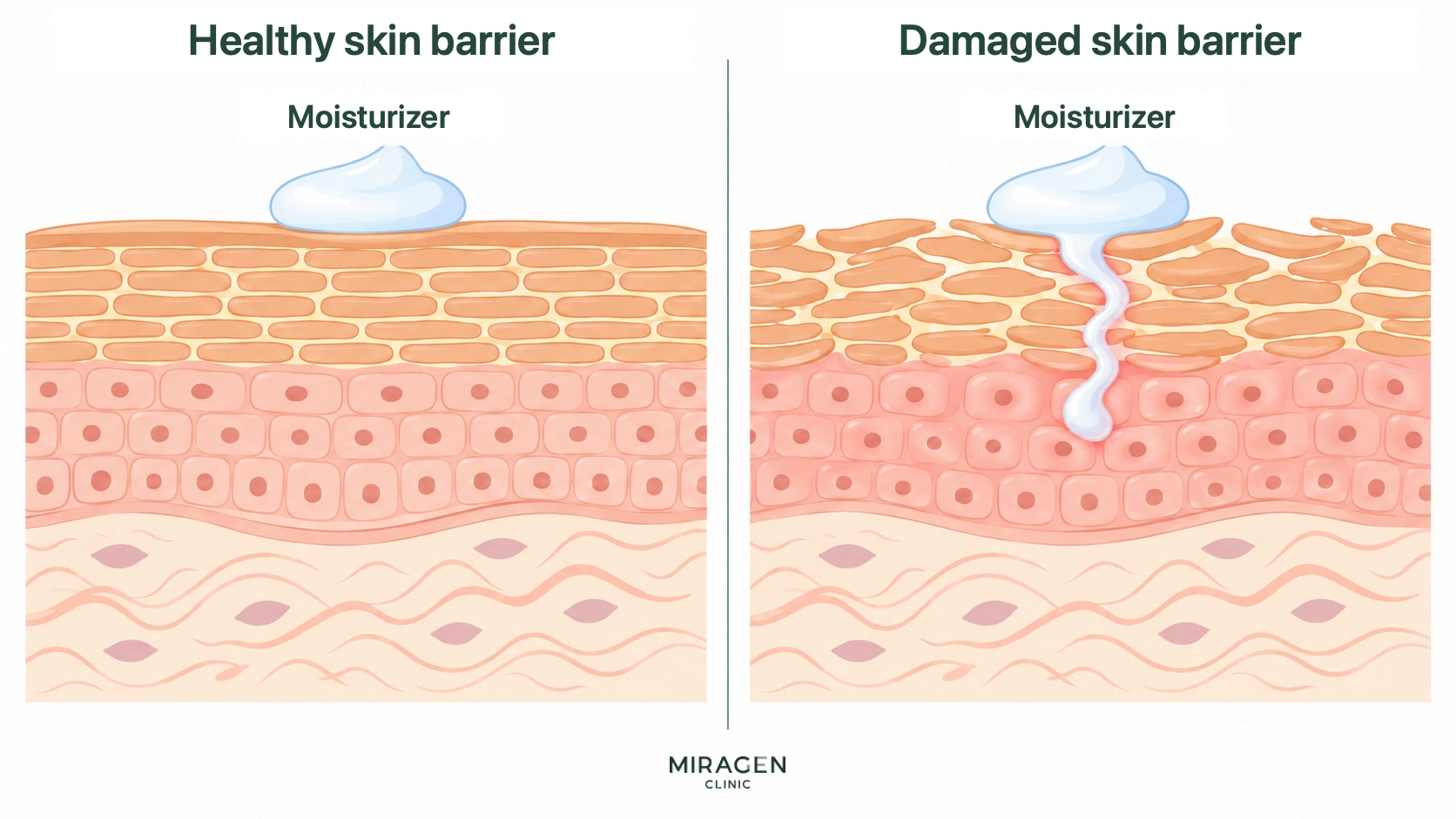 Illustration comparing how, with a healthy skin barrier, moisturizer stays on the surface, whereas with a damaged skin barrier, some of the moisturizer penetrates into the skin