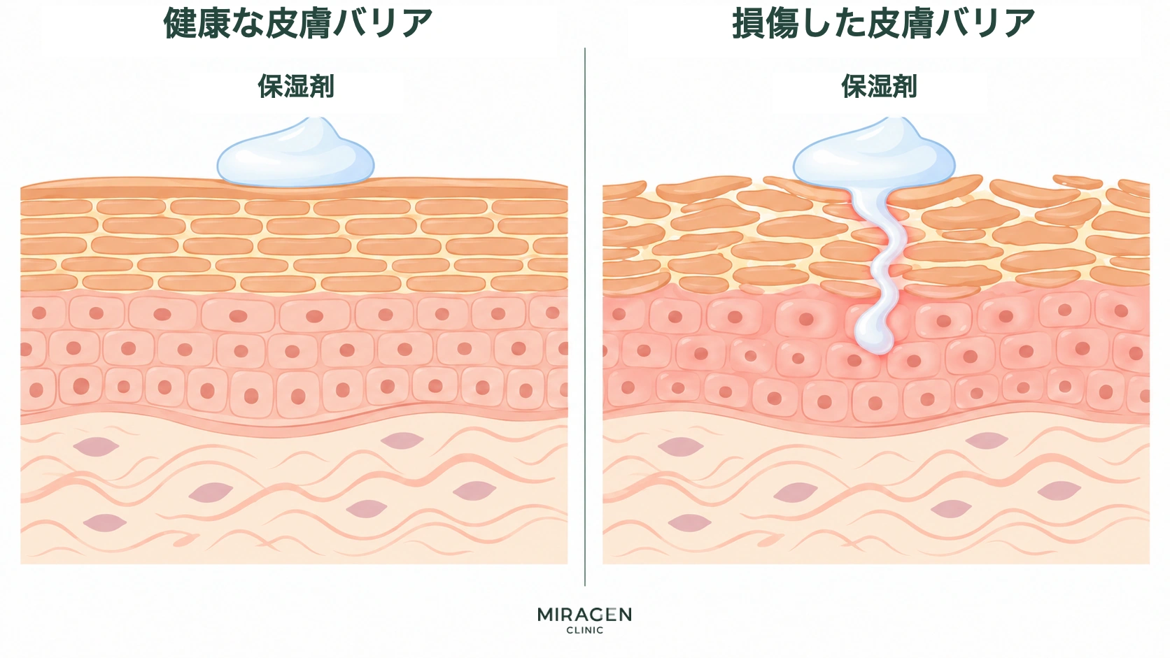 健康な皮膚バリアでは保湿剤が表面に留まり、損傷した皮膚バリアでは保湿剤の一部が皮膚の内側に浸透する様子を比較した図