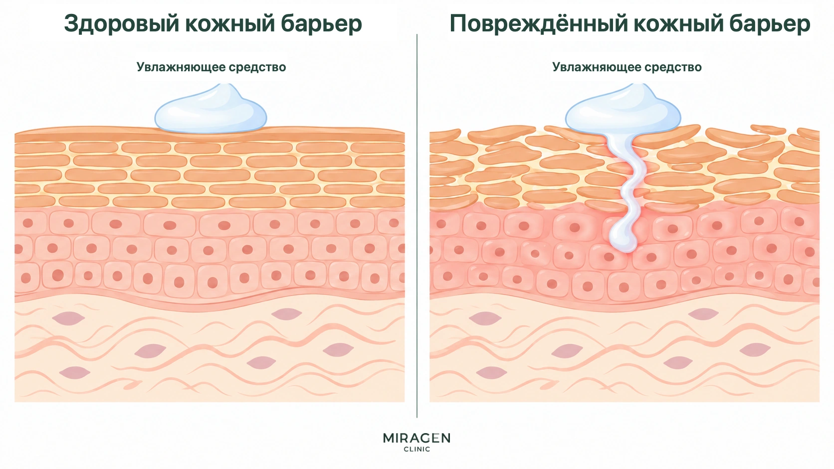 Сравнение: на здоровой коже увлажняющий крем остаётся на поверхности, а через повреждённый барьер часть его компонентов проникает глубже