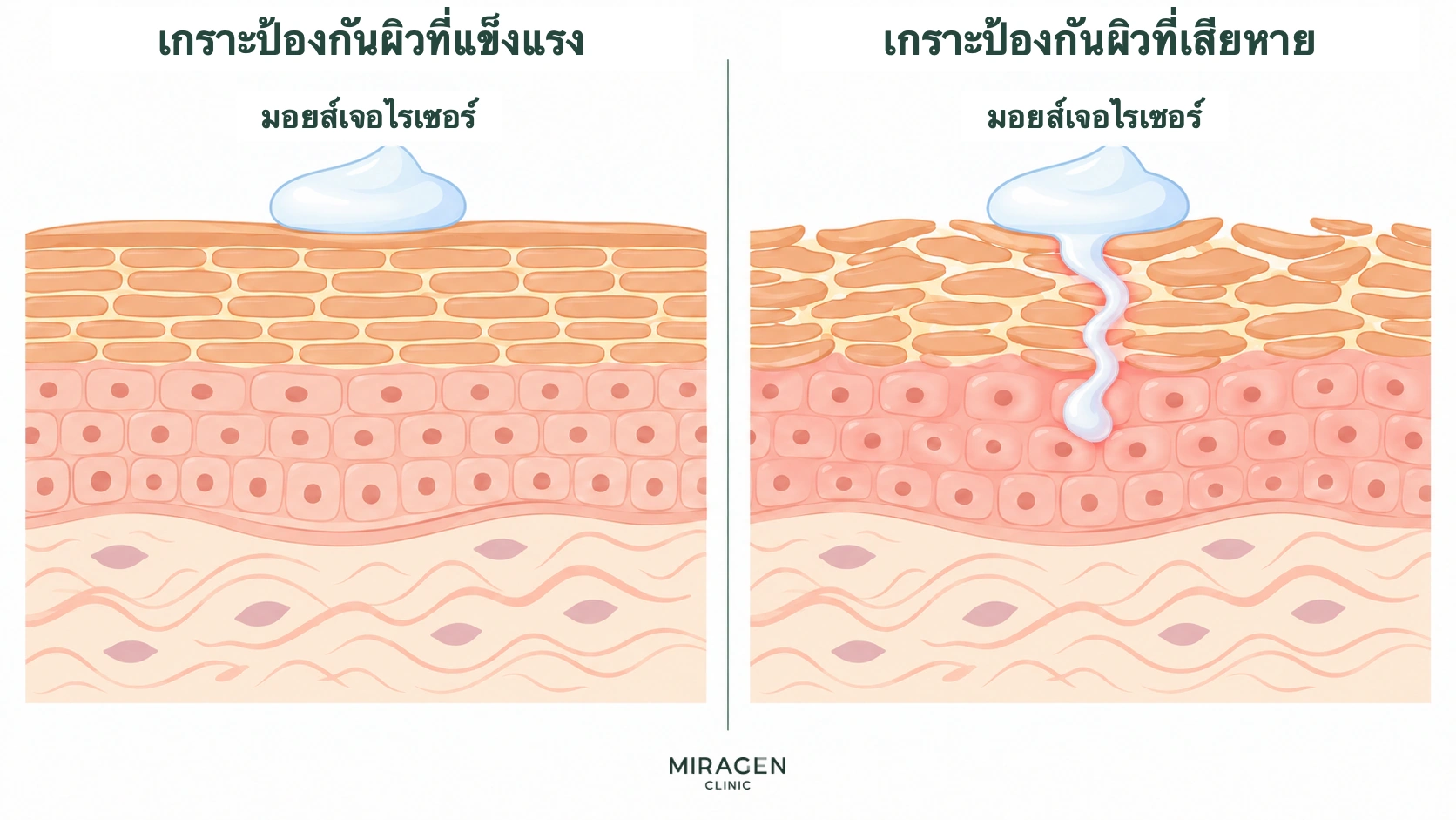 ภาพเปรียบเทียบที่ผลิตภัณฑ์ให้ความชุ่มชื้นคงอยู่บนผิวเมื่อเกราะป้องกันผิวแข็งแรง แต่บางส่วนซึมลงไปเมื่อเกราะเสีย