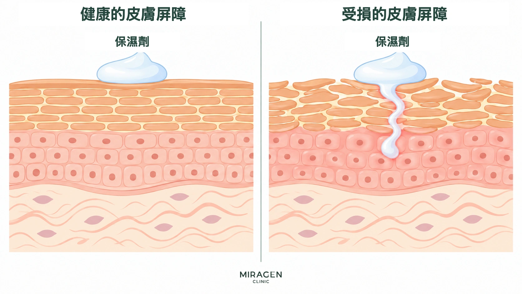 比較健康皮膚屏障與受損屏障的資訊圖：前者使保濕劑留在表面，後者可能讓部分成分進入皮膚內部