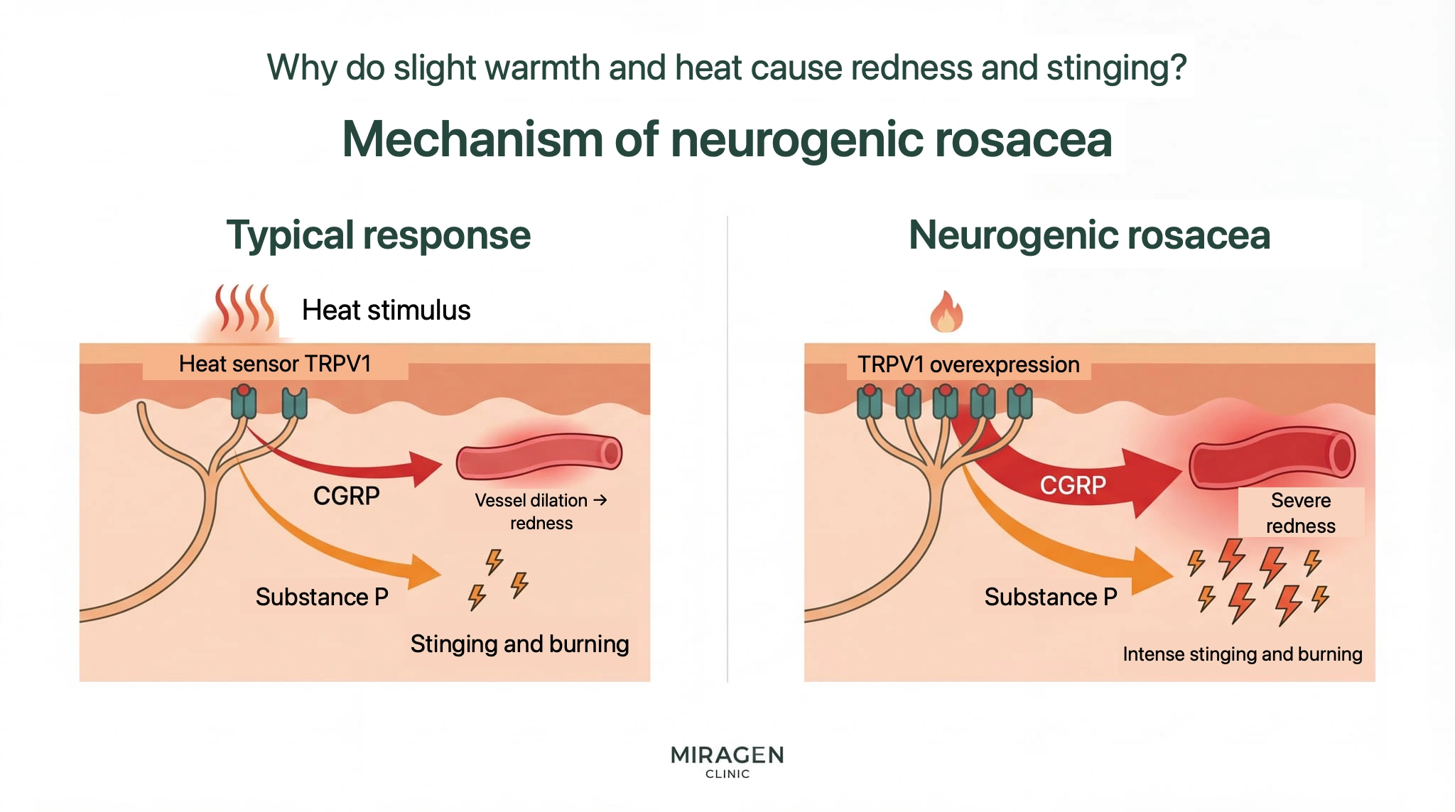 An illustration showing the mechanism of neurogenic rosacea. The left side compares the process where heat stimulation activates TRPV1 receptors in normal skin to release CGRP and Substance P, while the right side shows the process where much stronger flushing and burning occur in skin with TRPV1 overexpression under the same stimulation.