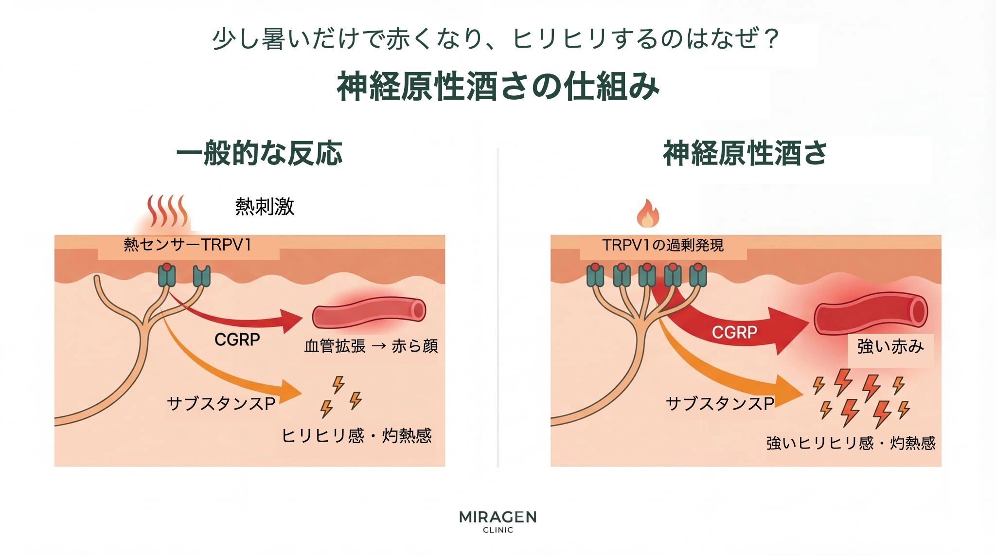 神経性酒さ皮膚炎のメカニズムを示すイラスト。左は正常な皮膚で熱刺激がTRPV1受容体を活性化し、CGRPとサブスタンスPを放出する過程、右はTRPV1が過剰発現した皮膚で同じ刺激に対してはるかに強い紅潮と灼熱感が発生する過程を比較。 