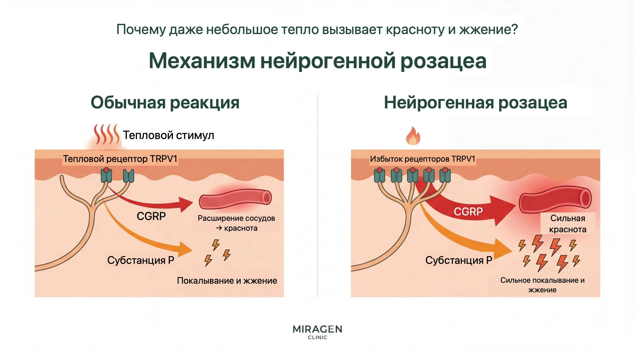 Иллюстрация сравнивает действие TRPV1 при нейрогенной розацеа: слева тепловое раздражение нормальной кожи высвобождает CGRP и вещество P, справа при избыточной экспрессии TRPV1 тот же стимул вызывает гораздо более сильное покраснение и жжение