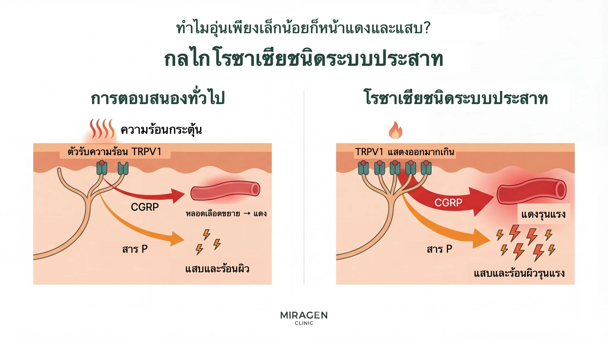 ภาพเปรียบเทียบผิวปกติและผิวที่มี TRPV1 มากเกินไป เมื่อได้รับความร้อนเท่ากัน ผิวแบบหลังปล่อย CGRP และ substance P มากกว่า ทำให้หน้าแดงและแสบร้อนรุนแรงกว่า