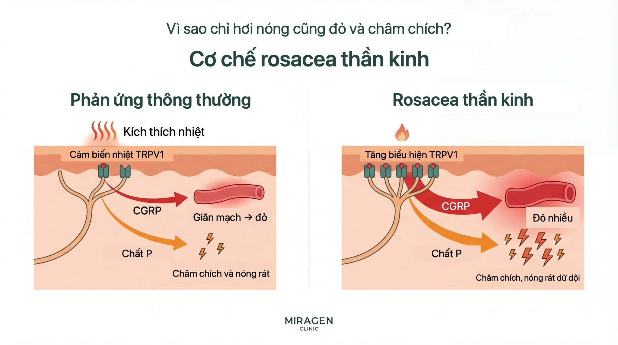 Minh họa so sánh cơ chế rosacea do thần kinh: bên trái, kích thích nhiệt kích hoạt TRPV1 ở da bình thường và phóng thích CGRP, substance P; bên phải, cùng kích thích gây đỏ và nóng rát mạnh hơn nhiều ở da biểu hiện TRPV1 quá mức