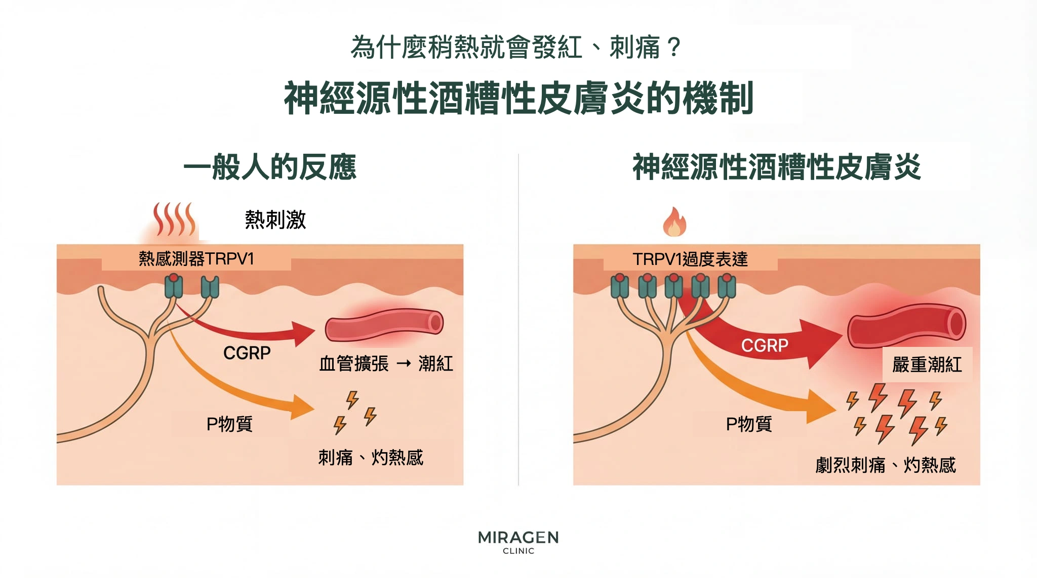 神經源性酒糟性皮膚炎機制示意圖：左側正常皮膚受熱後，TRPV1 啟用並釋放 CGRP 與 P 物質；右側 TRPV1 表達增多的皮膚，在同樣刺激下出現更強烈的潮紅和灼熱感