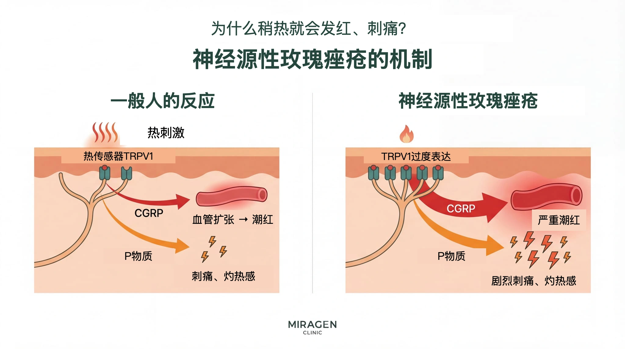 神经源性玫瑰痤疮机制示意图：左侧正常皮肤受热后，TRPV1 激活并释放 CGRP 与 P 物质；右侧 TRPV1 表达增多的皮肤，在同样刺激下出现更强烈的潮红和灼热感