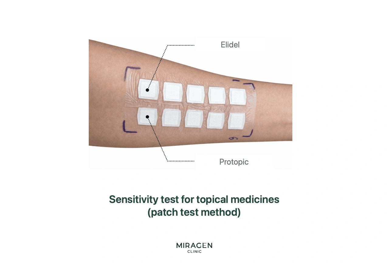 A photo of a patch test with topical agents such as Soolantra and Protopic applied to the inner arm.